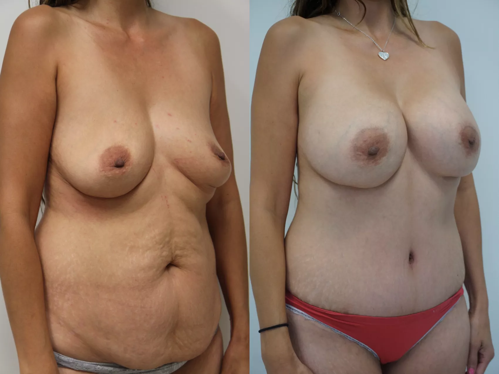 Mommy makeover Turkey Case 7 - Dramatic body transformation