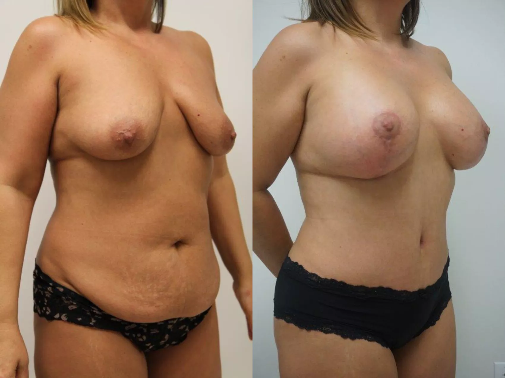 Mommy makeover Turkey Case 8 - Pre-pregnancy body restored