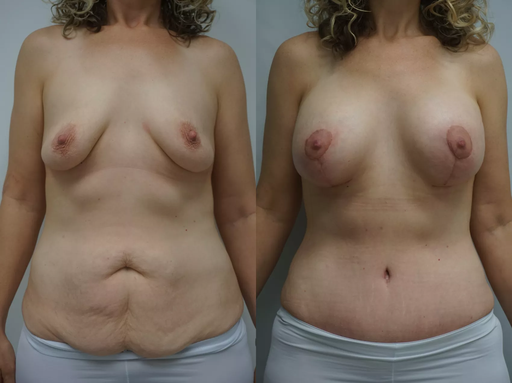 Mommy makeover Turkey Case 9