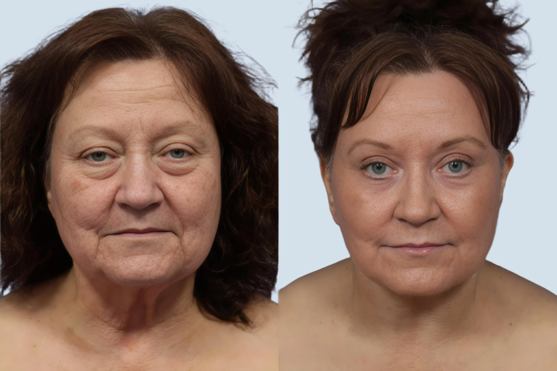 Neck lift Turkey before and after Photo 34