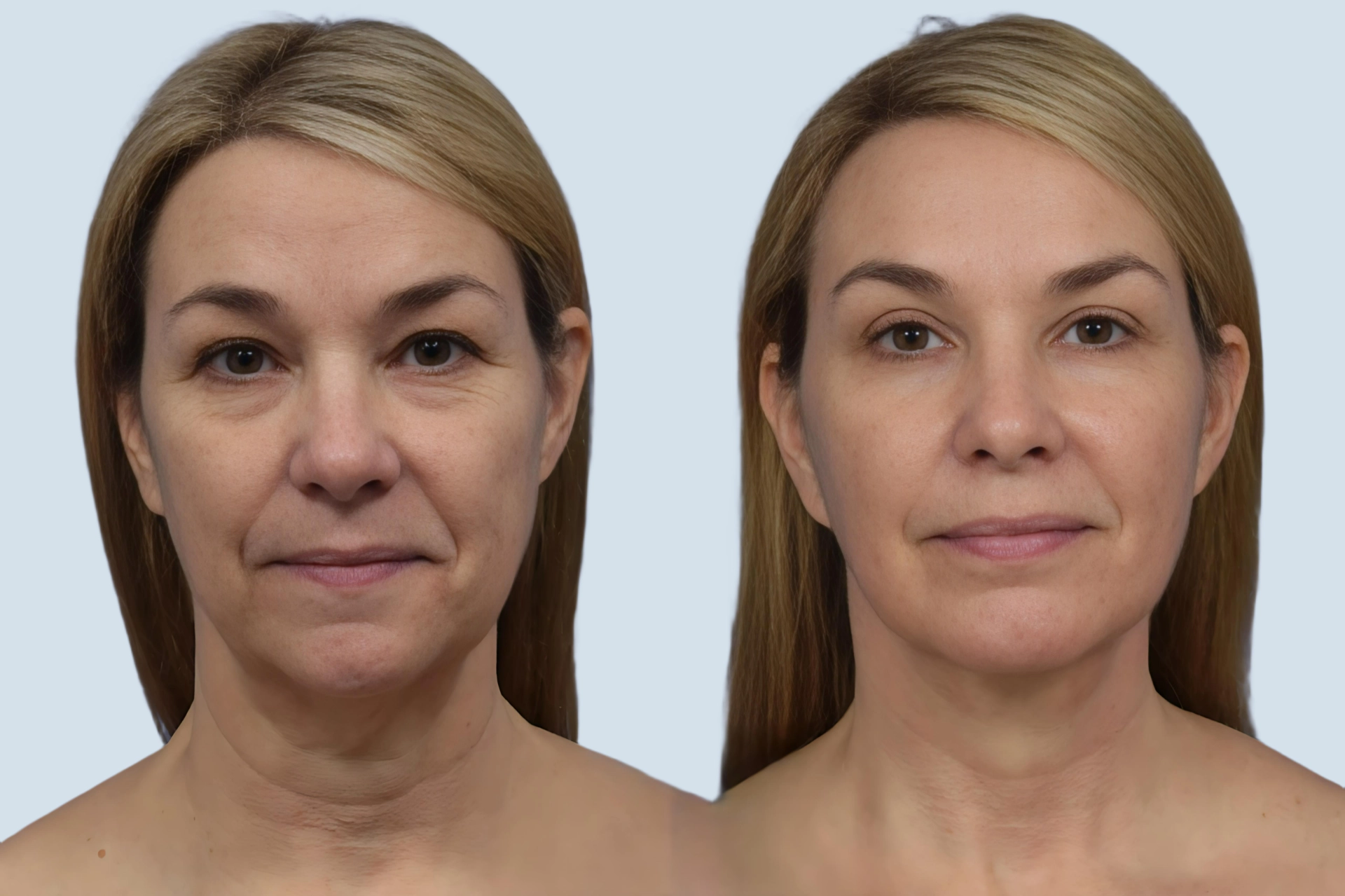 Neck lift Turkey before and after Photo 24
