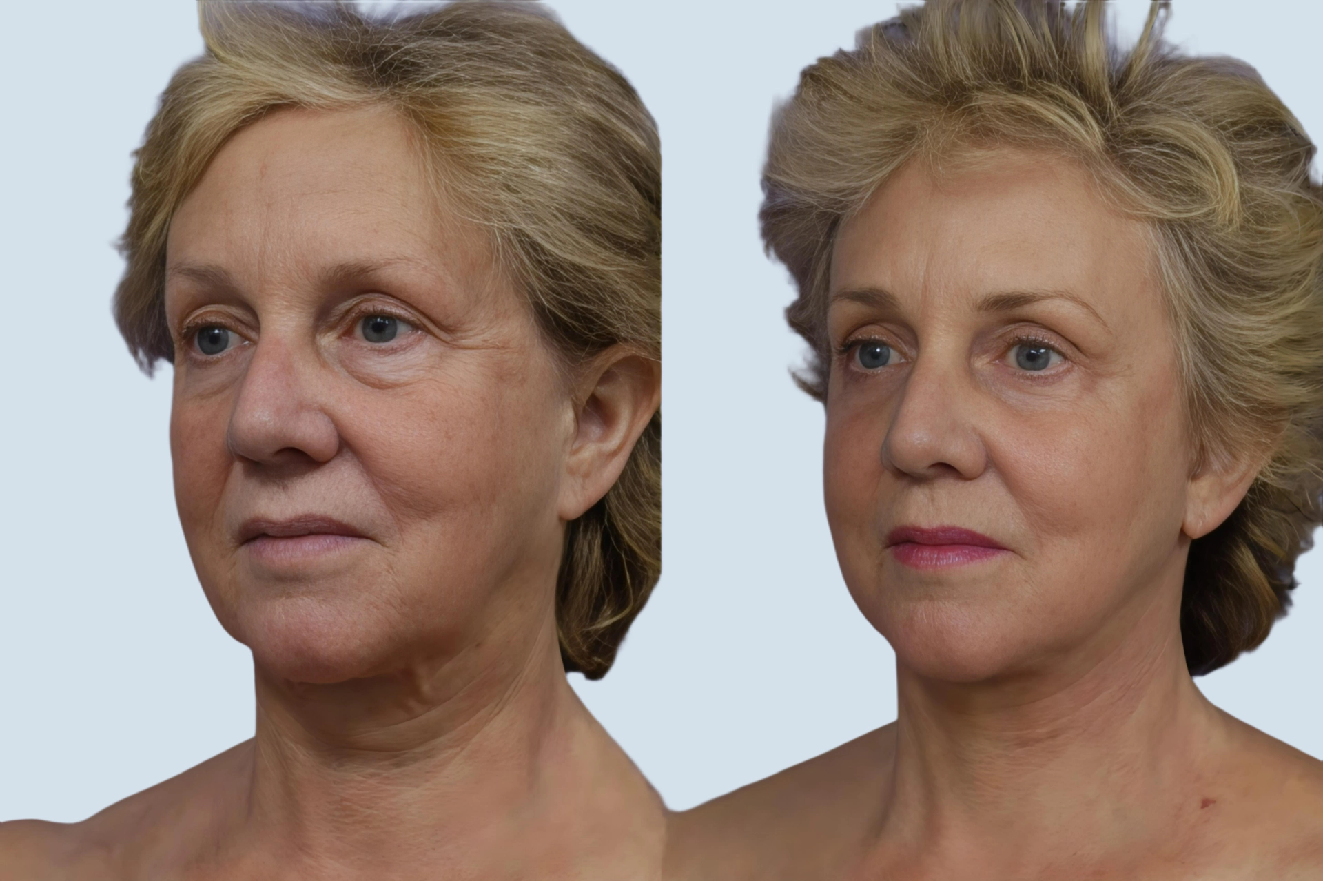 Neck lift Turkey before and after Photo 21