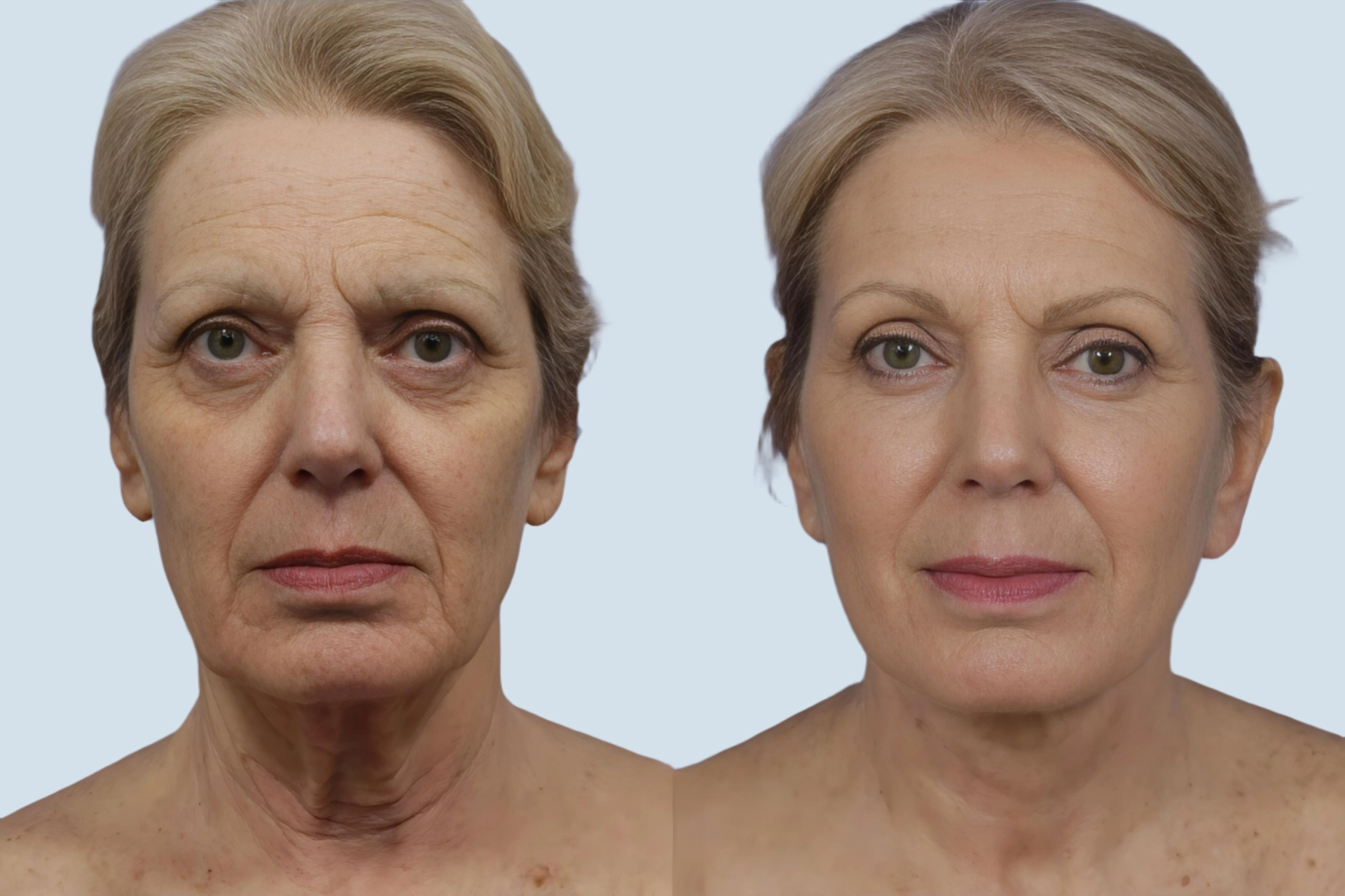 Neck lift Turkey before and after Photo 20