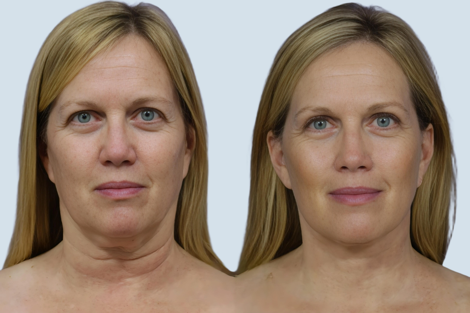 Neck lift Turkey before and after Photo 18