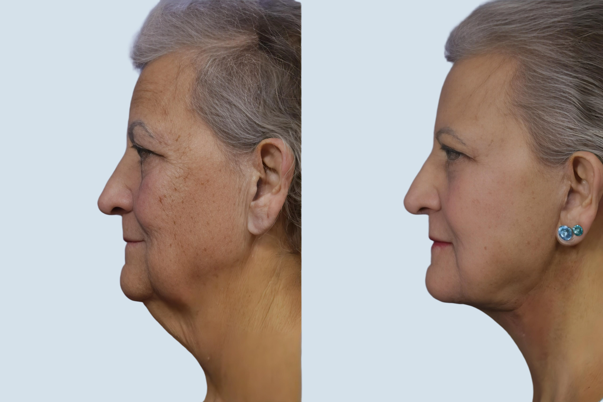 Neck lift Turkey before and after Photo 15
