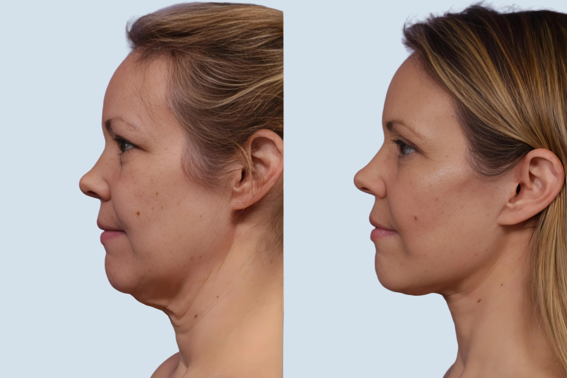 Neck lift Turkey before and after - platysmaplasty results at Carely Clinic Istanbul