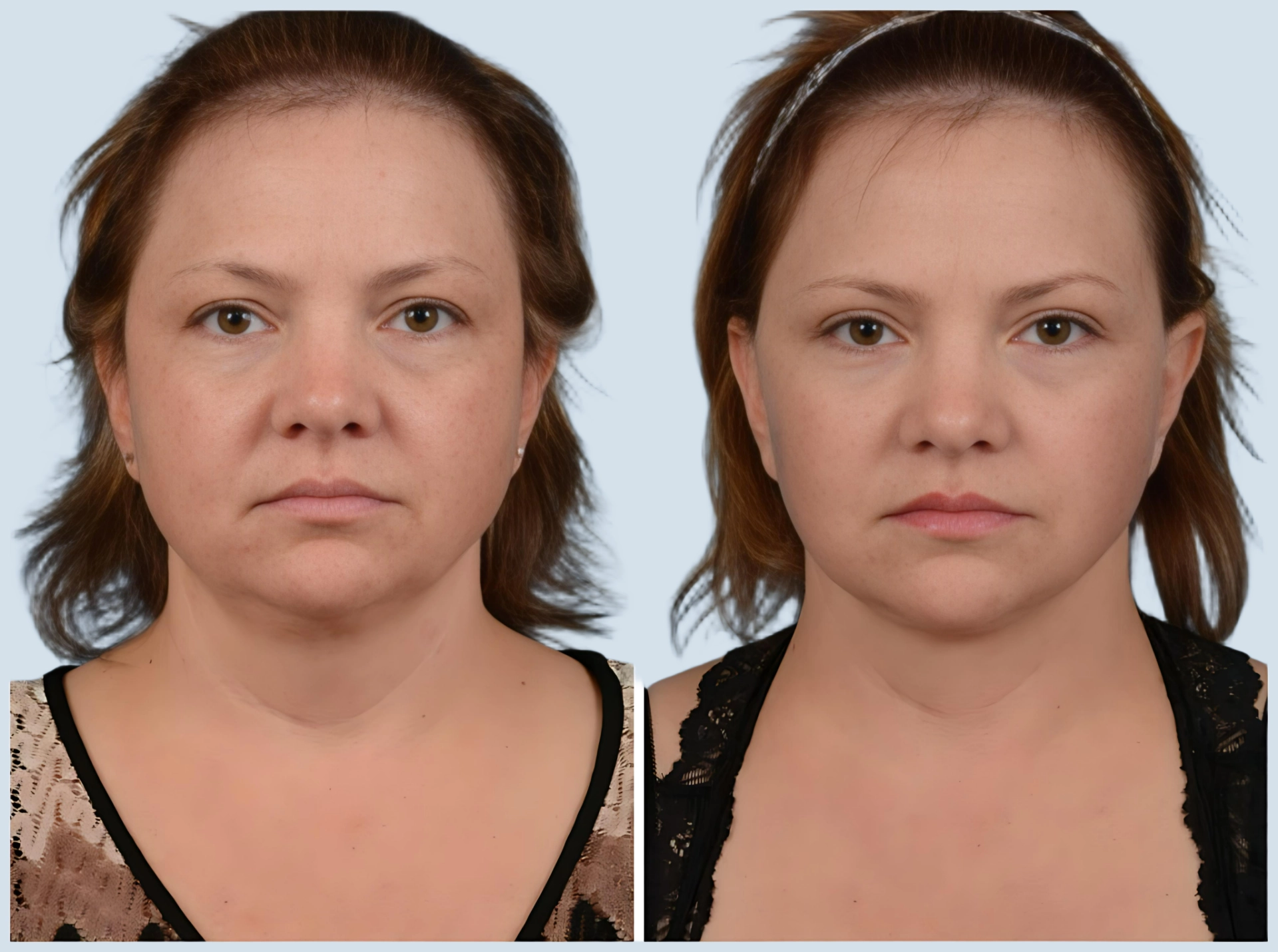 Neck lift Turkey before and after Photo 8