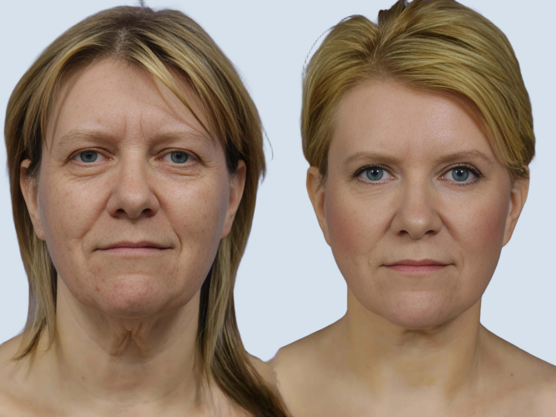 Neck lift Turkey before and after Photo 32