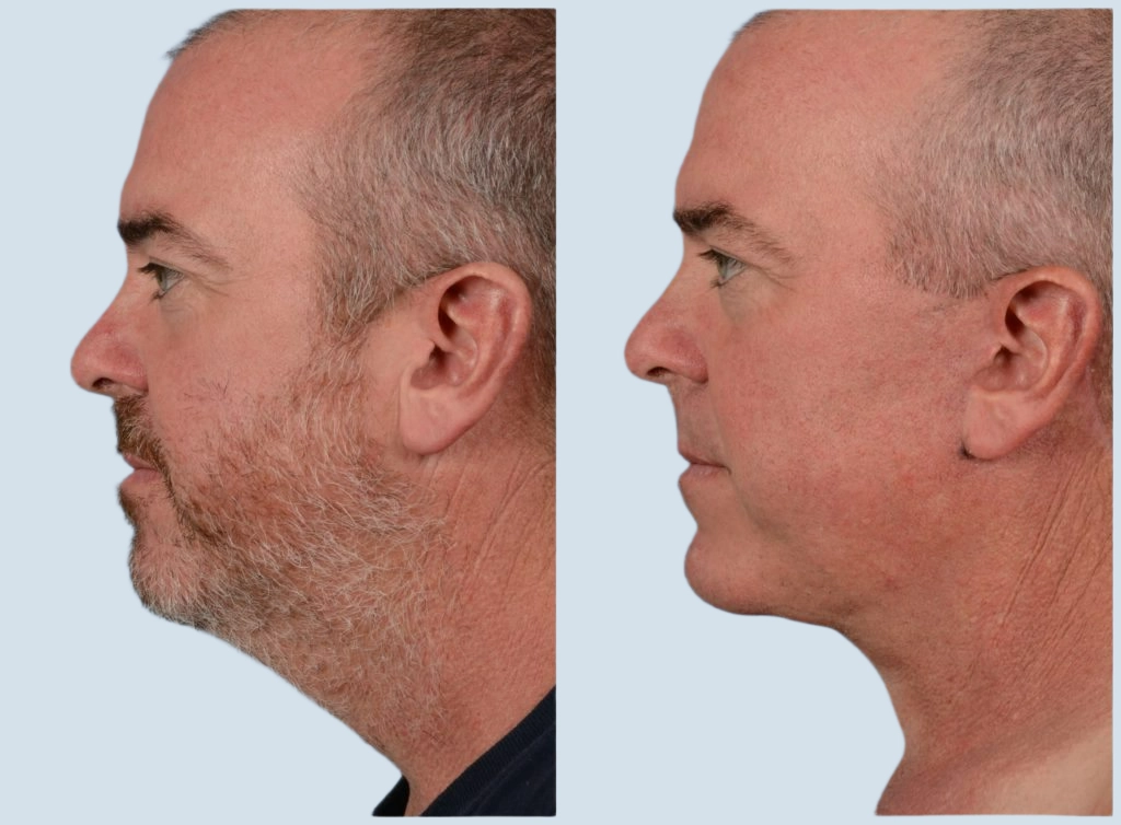 Neck lift Turkey before and after Photo 5