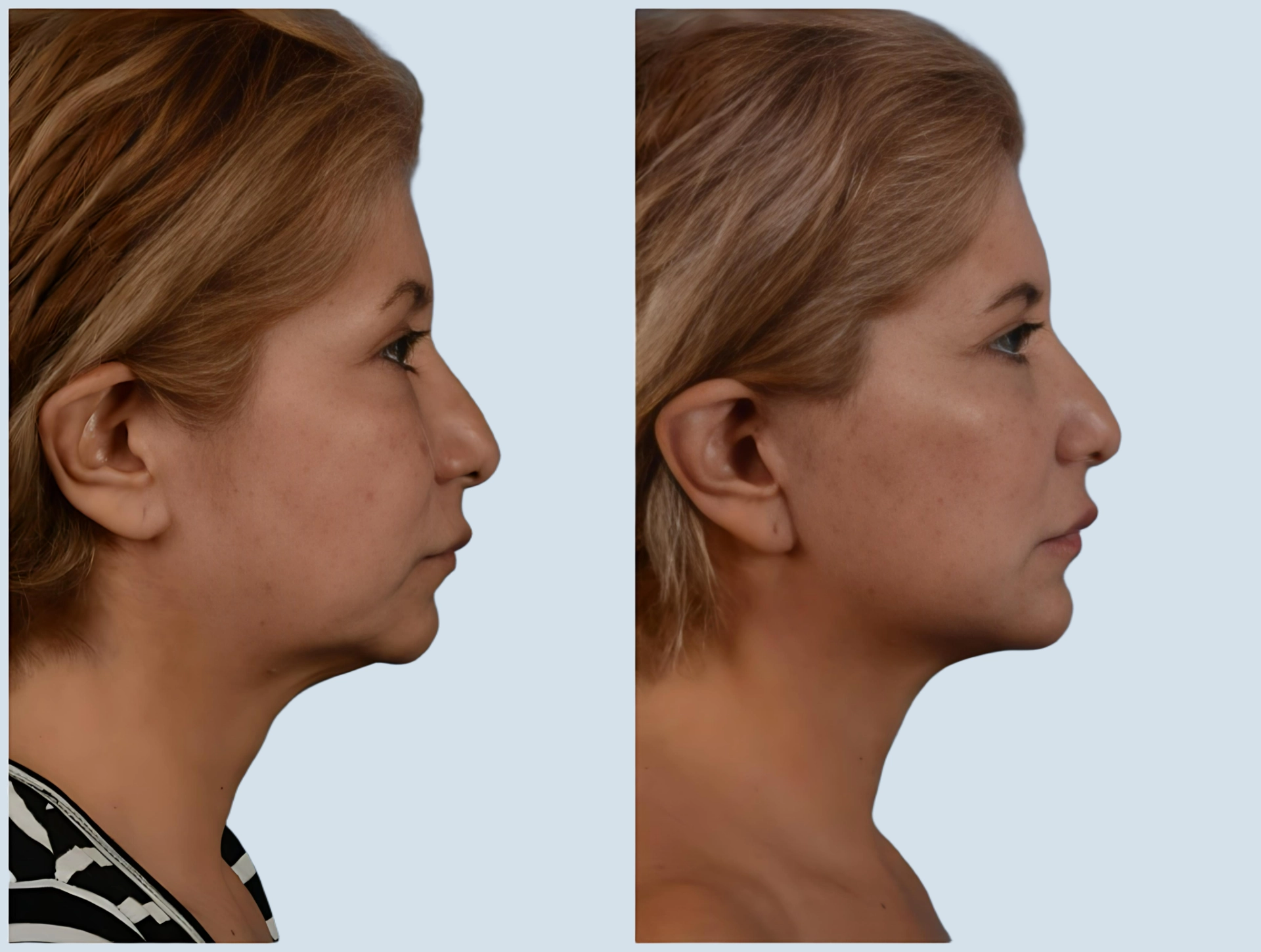 Neck lift Turkey before and after Photo 2