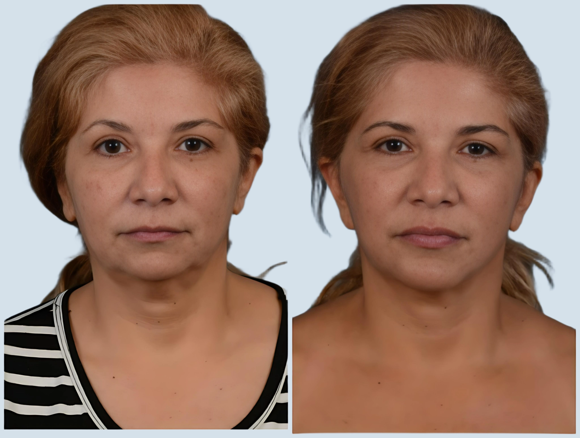 Neck lift Turkey before and after Photo 1 - Turkey neck correction at Carely Clinic Istanbul
