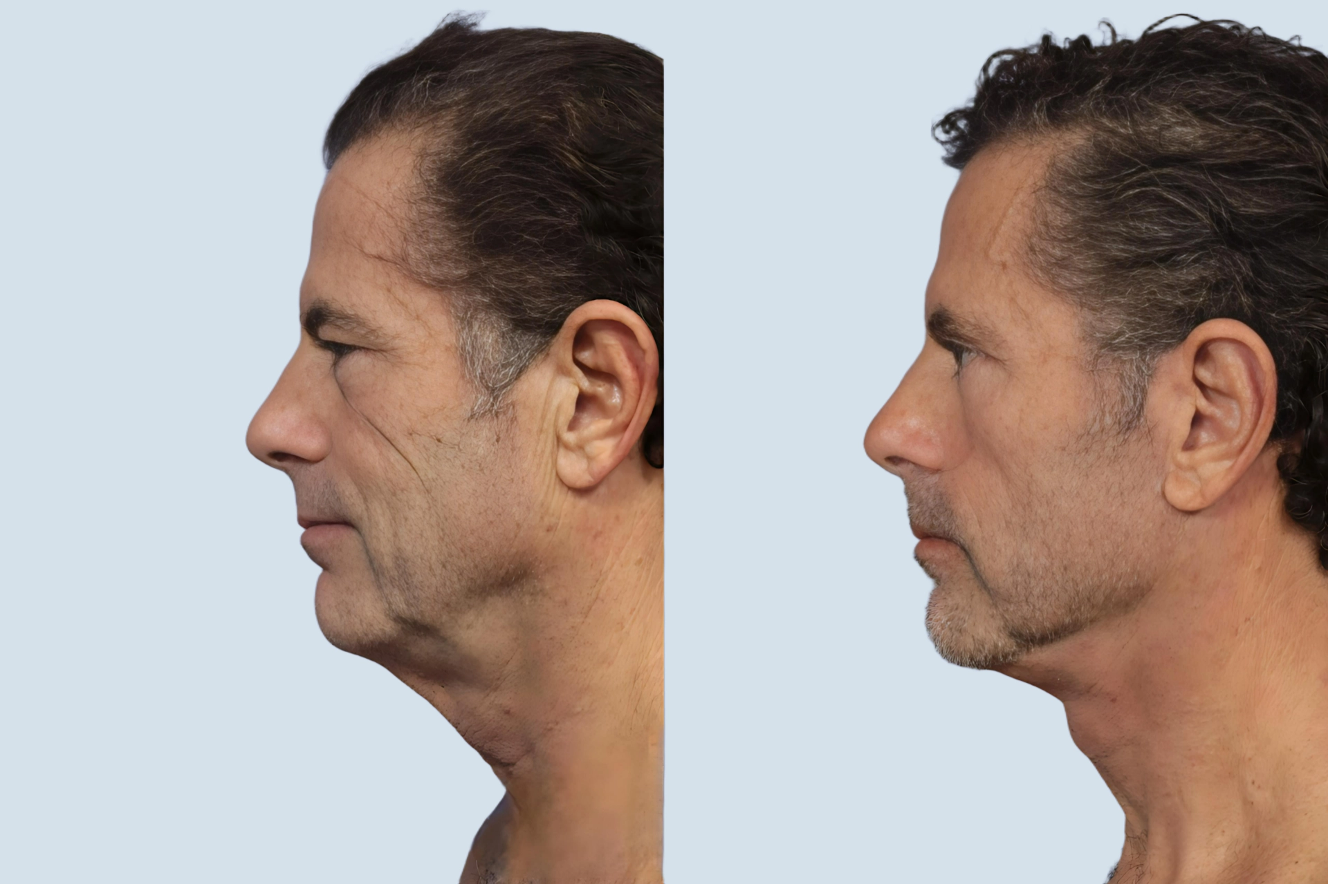 Neck lift Turkey before and after Photo 27
