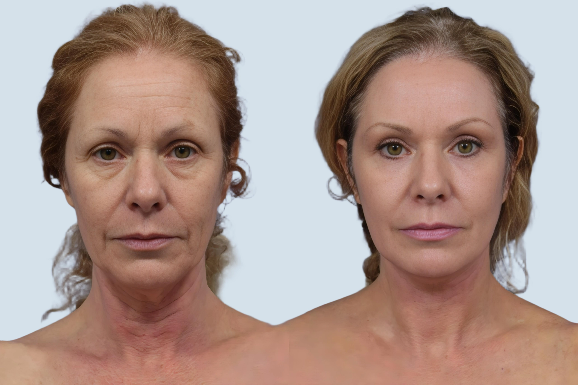 Neck lift Turkey before and after Photo 26