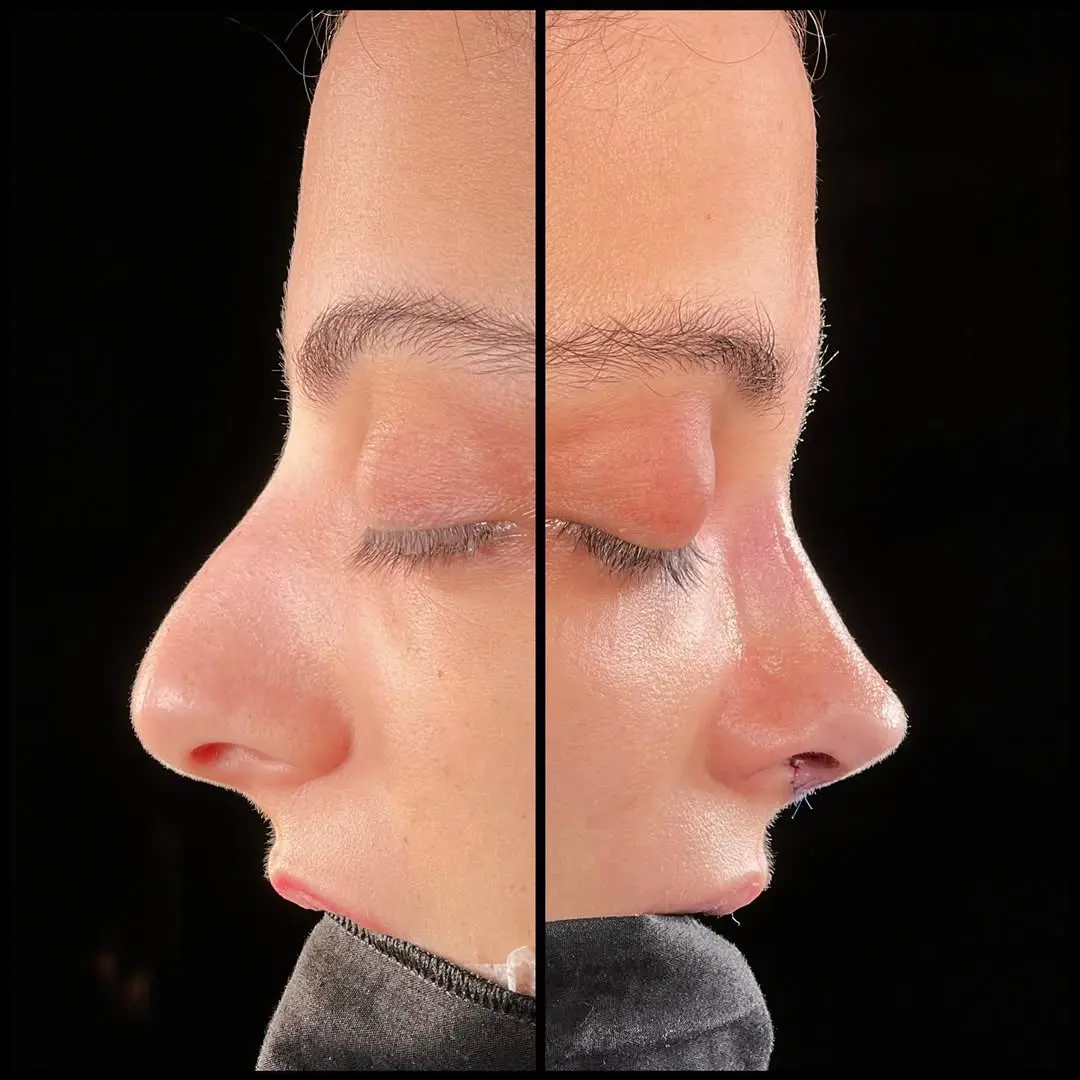 Rhinoplasty Turkey before and after gallery