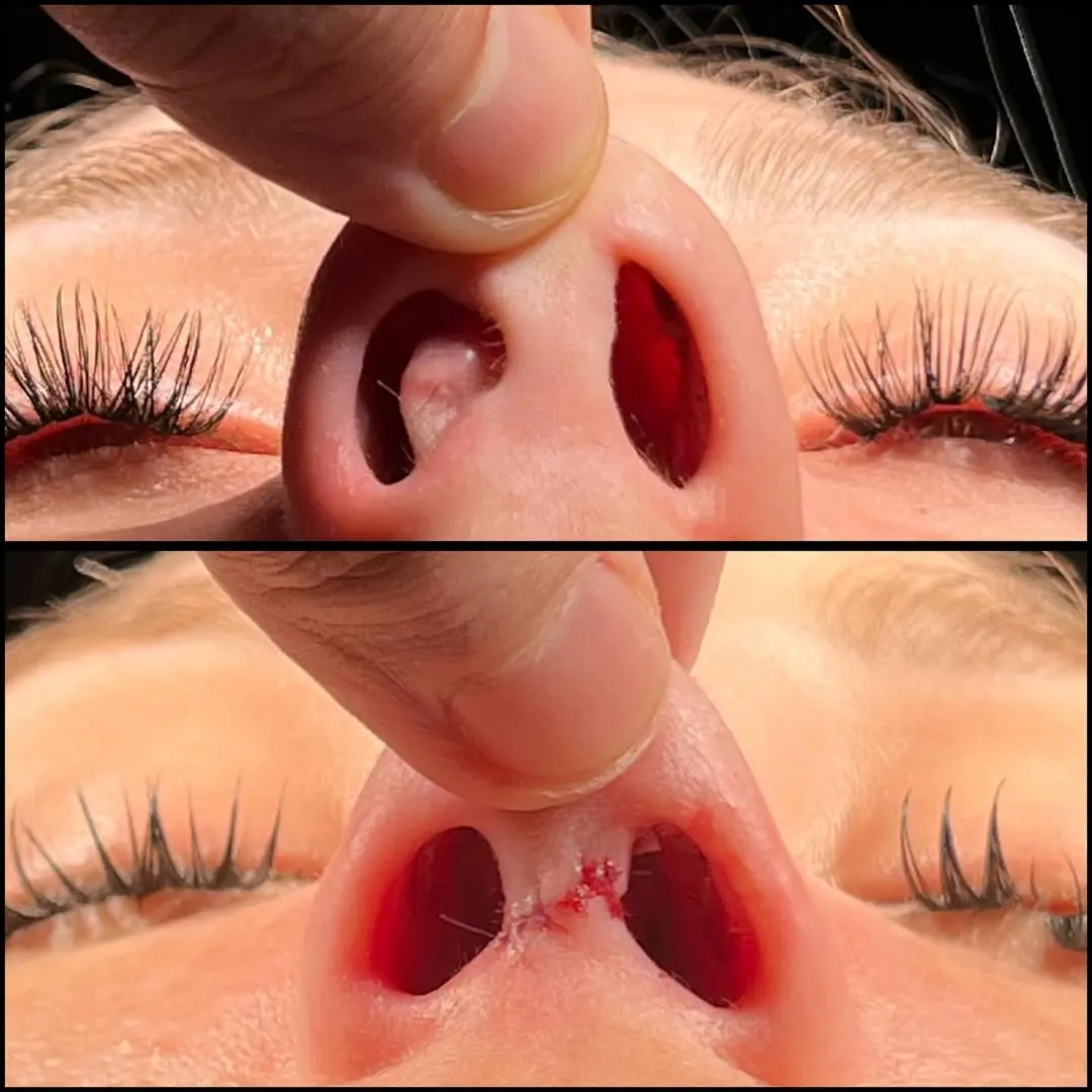 Rhinoplasty Turkey before and after Case 10