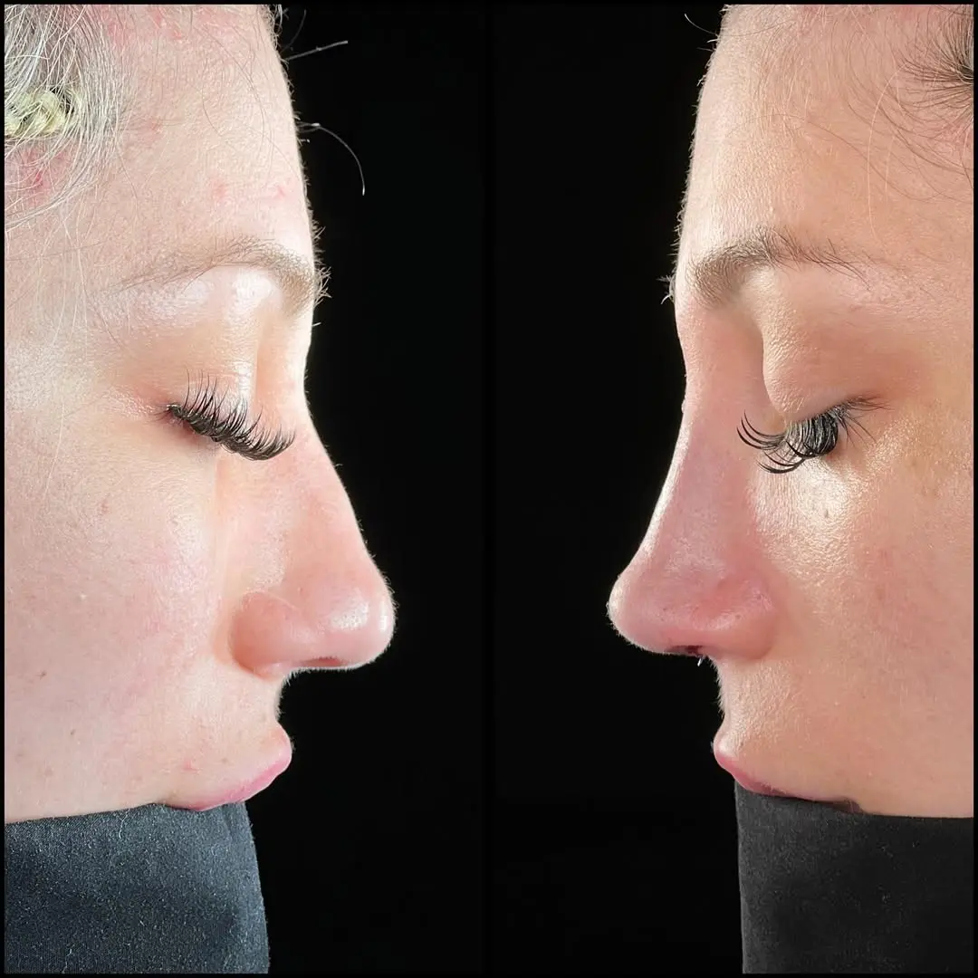 Rhinoplasty Turkey before and after Case 11