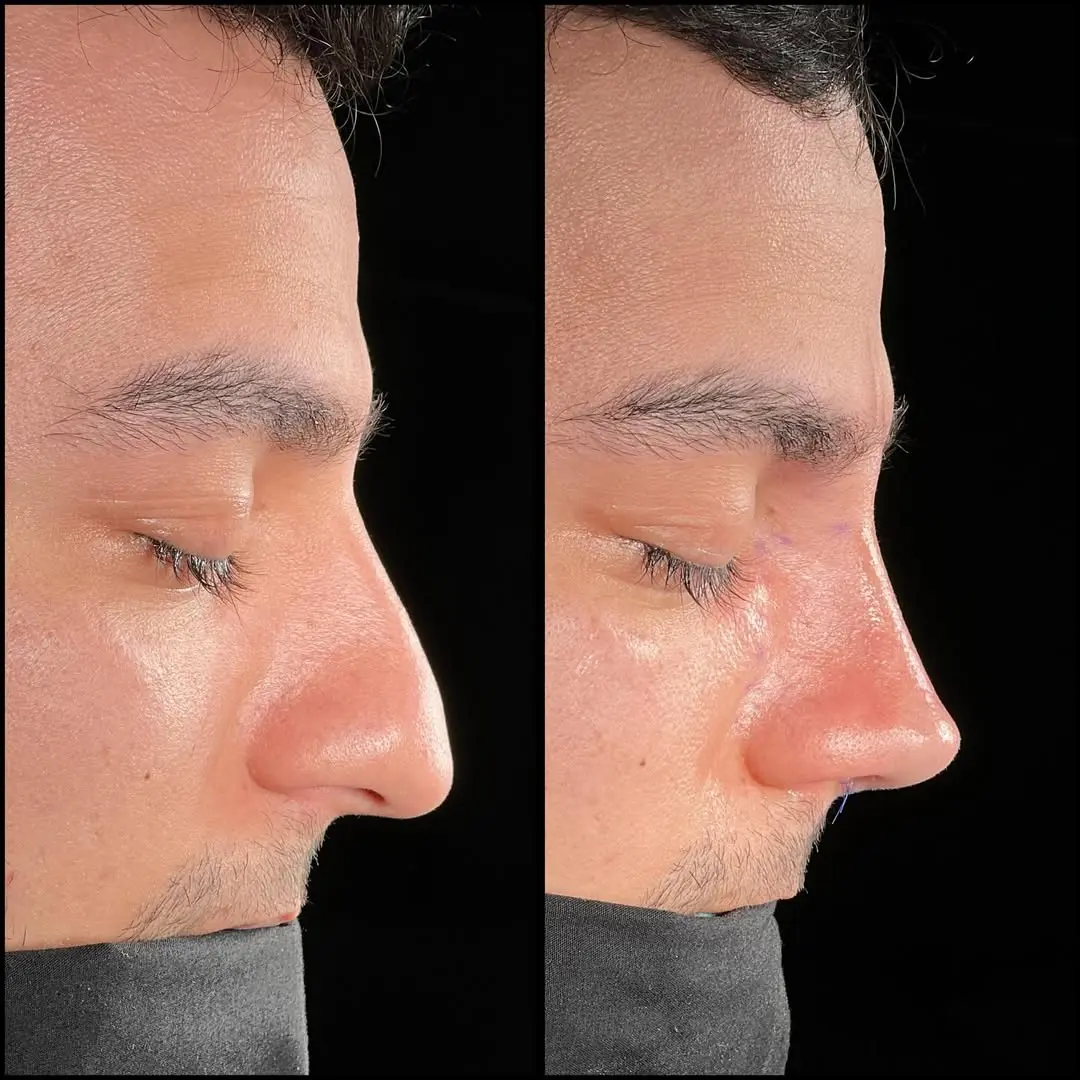 Rhinoplasty Turkey before and after Case 12