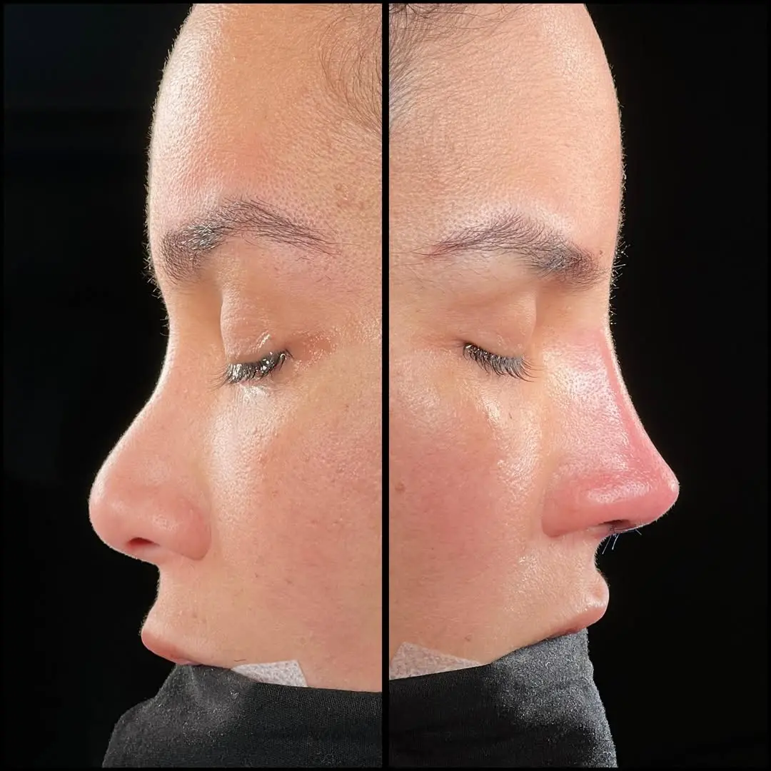 Rhinoplasty Turkey before and after Case 13