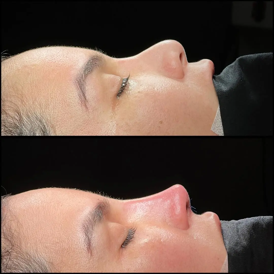 Rhinoplasty Turkey before and after Case 14