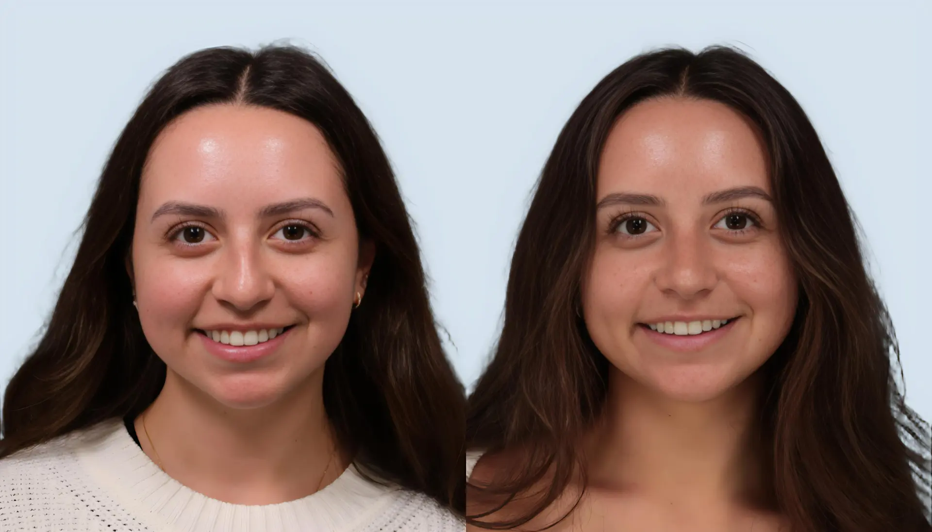 Rhinoplasty Turkey before and after Case 15