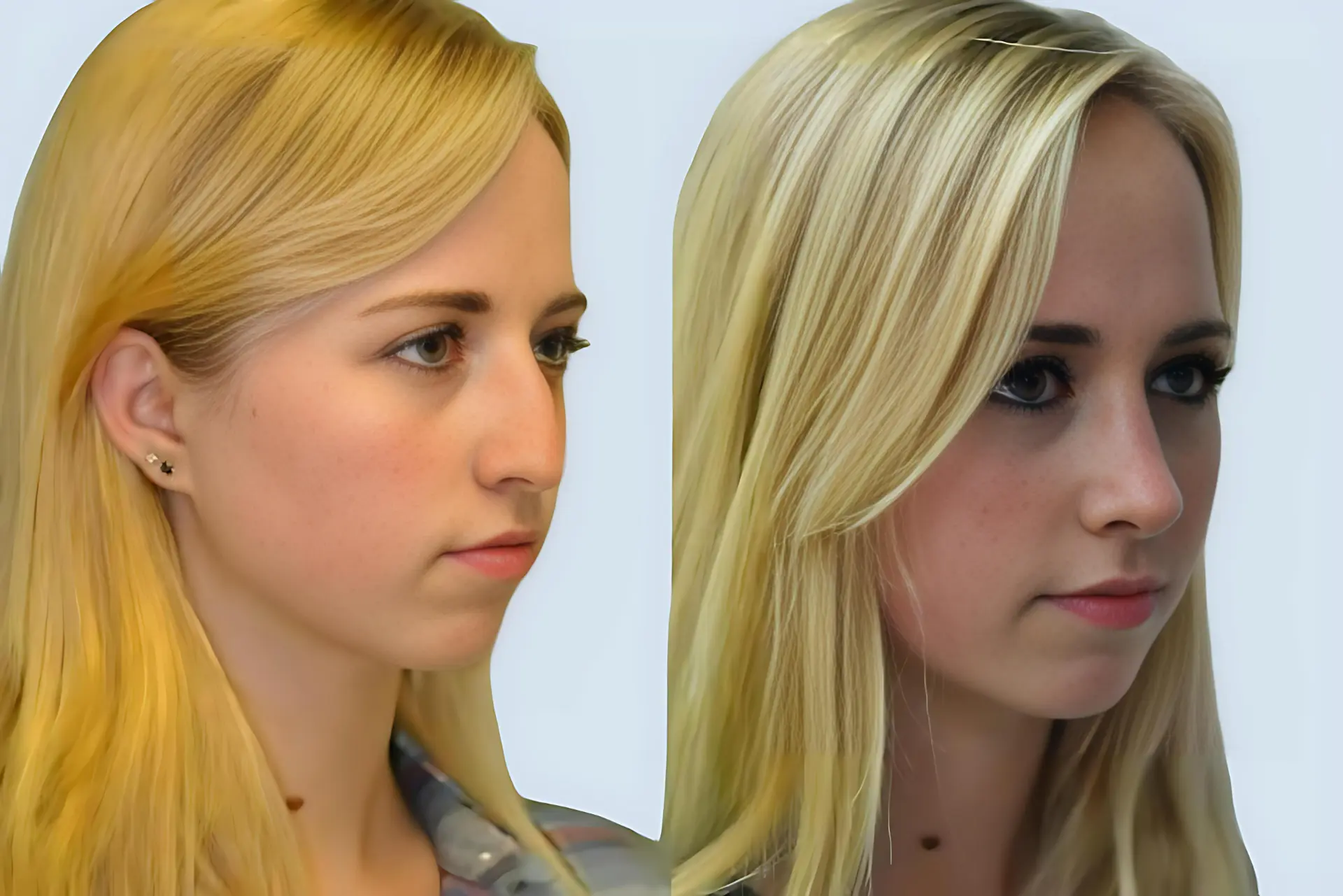 Rhinoplasty Turkey before and after Case 17