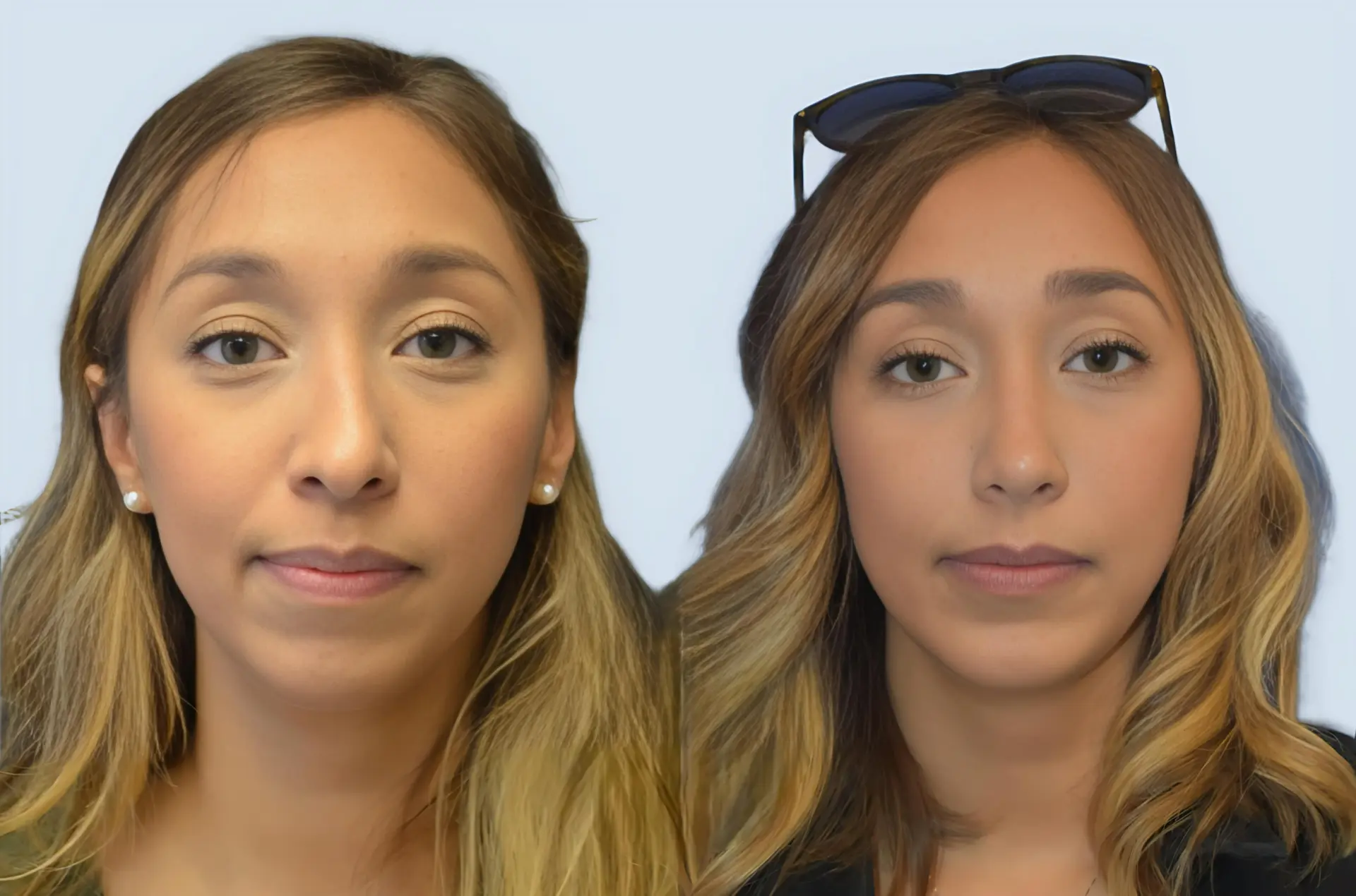 Rhinoplasty Turkey before and after Case 19