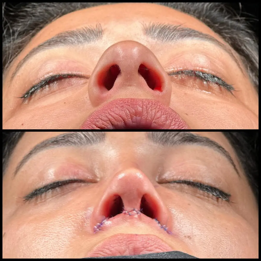 Rhinoplasty Turkey before and after Case 2