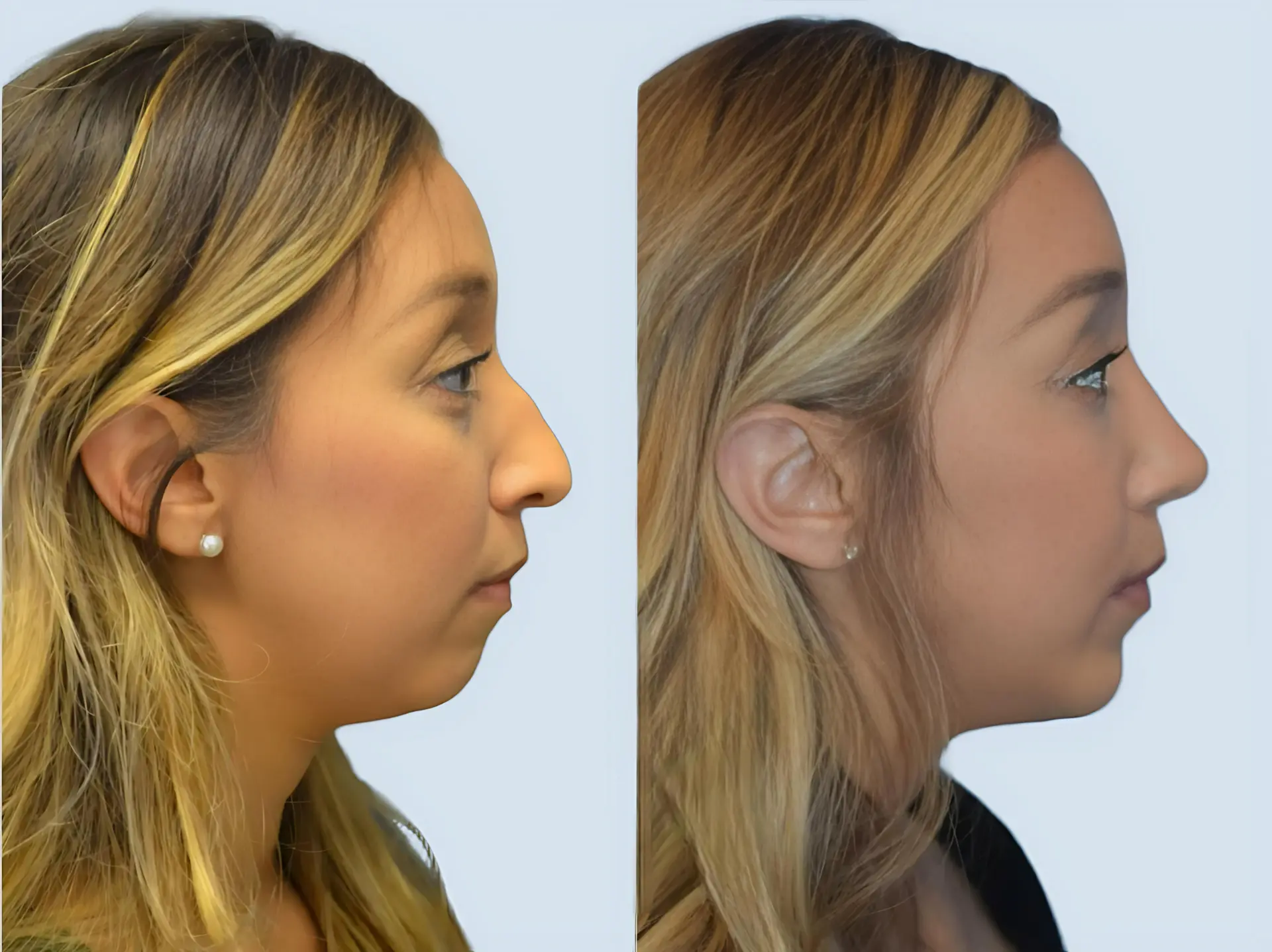 Rhinoplasty Turkey before and after Case 20