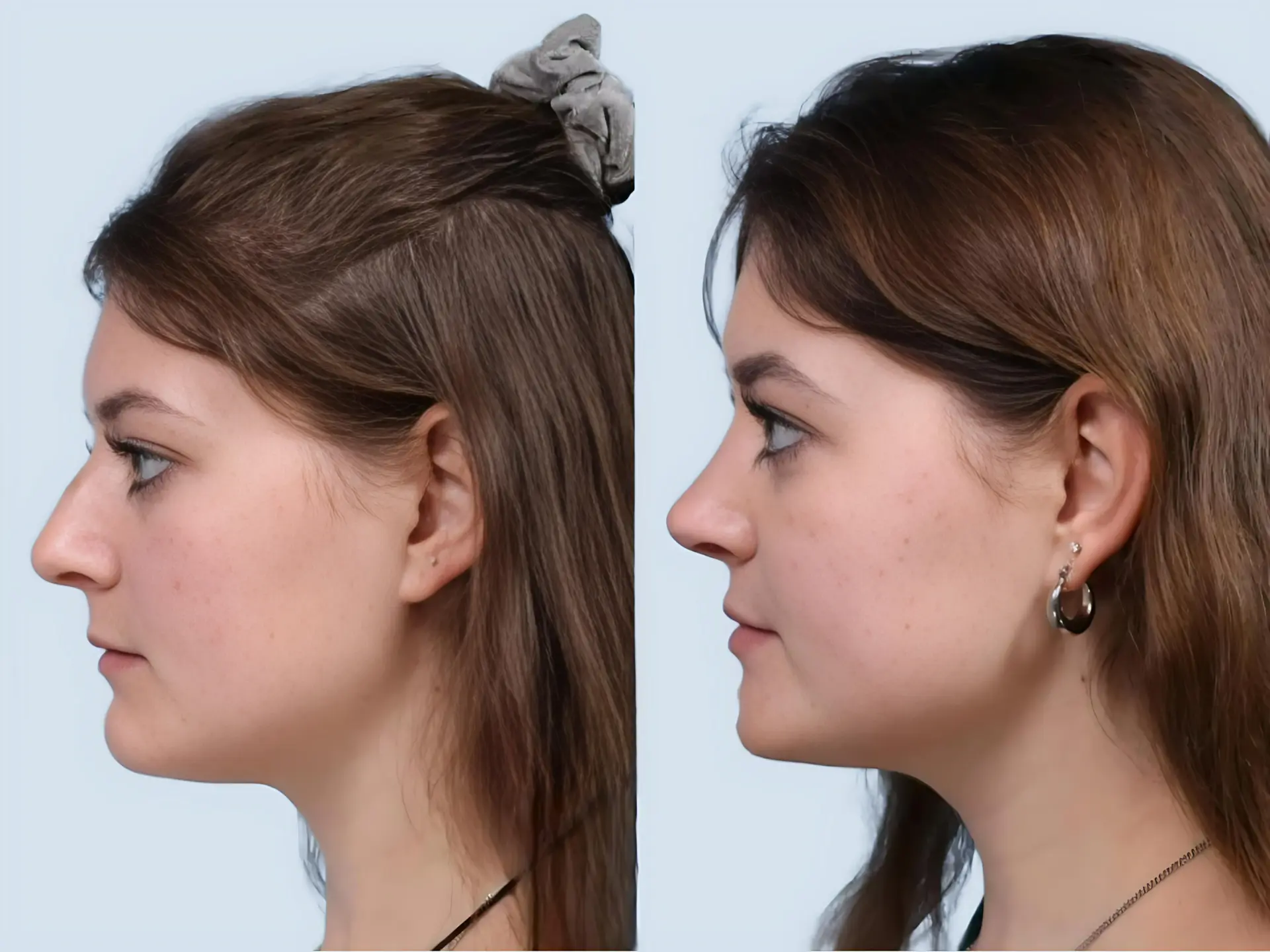 Rhinoplasty Turkey before and after Case 22