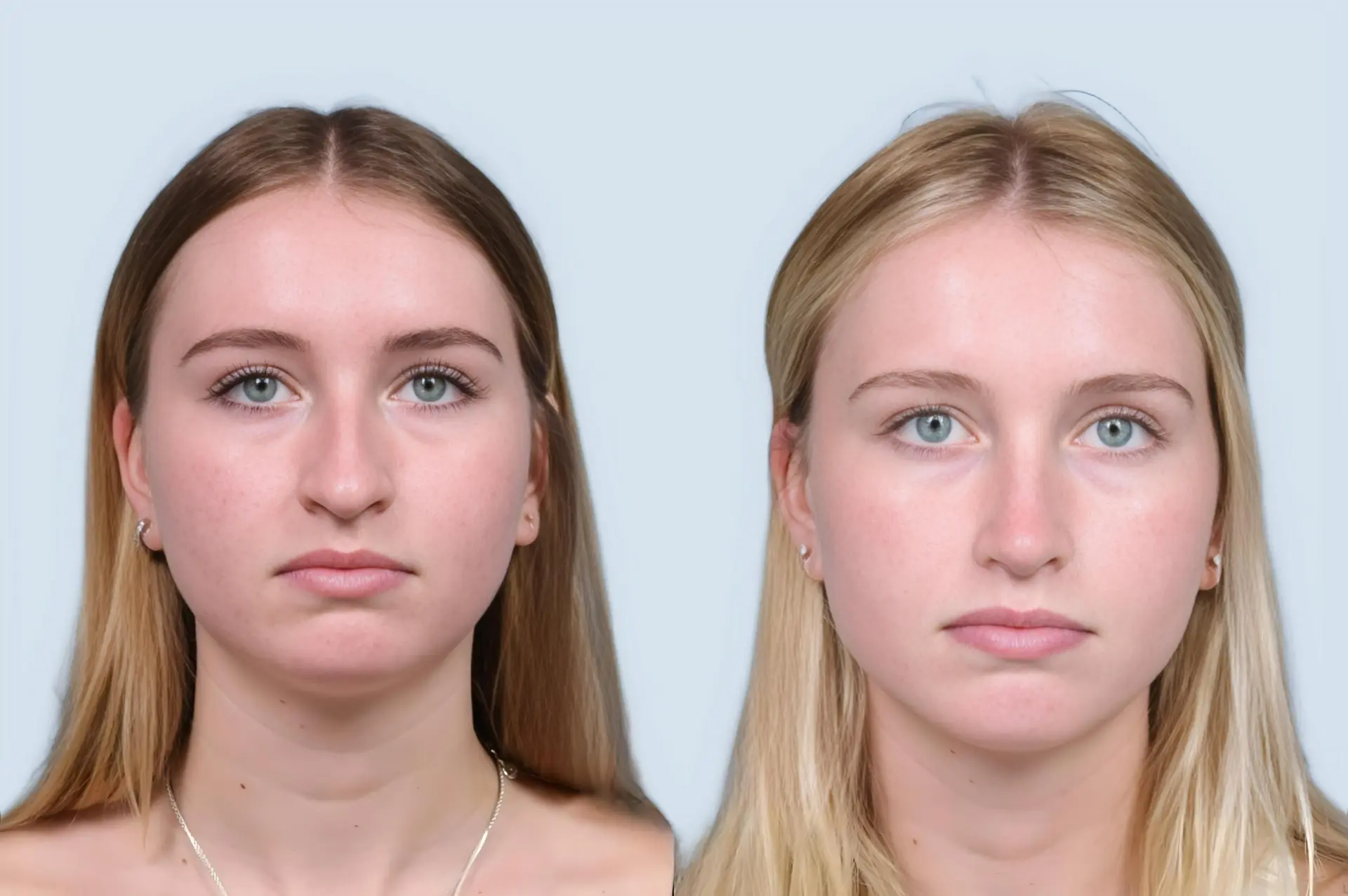 Rhinoplasty Turkey before and after Case 23