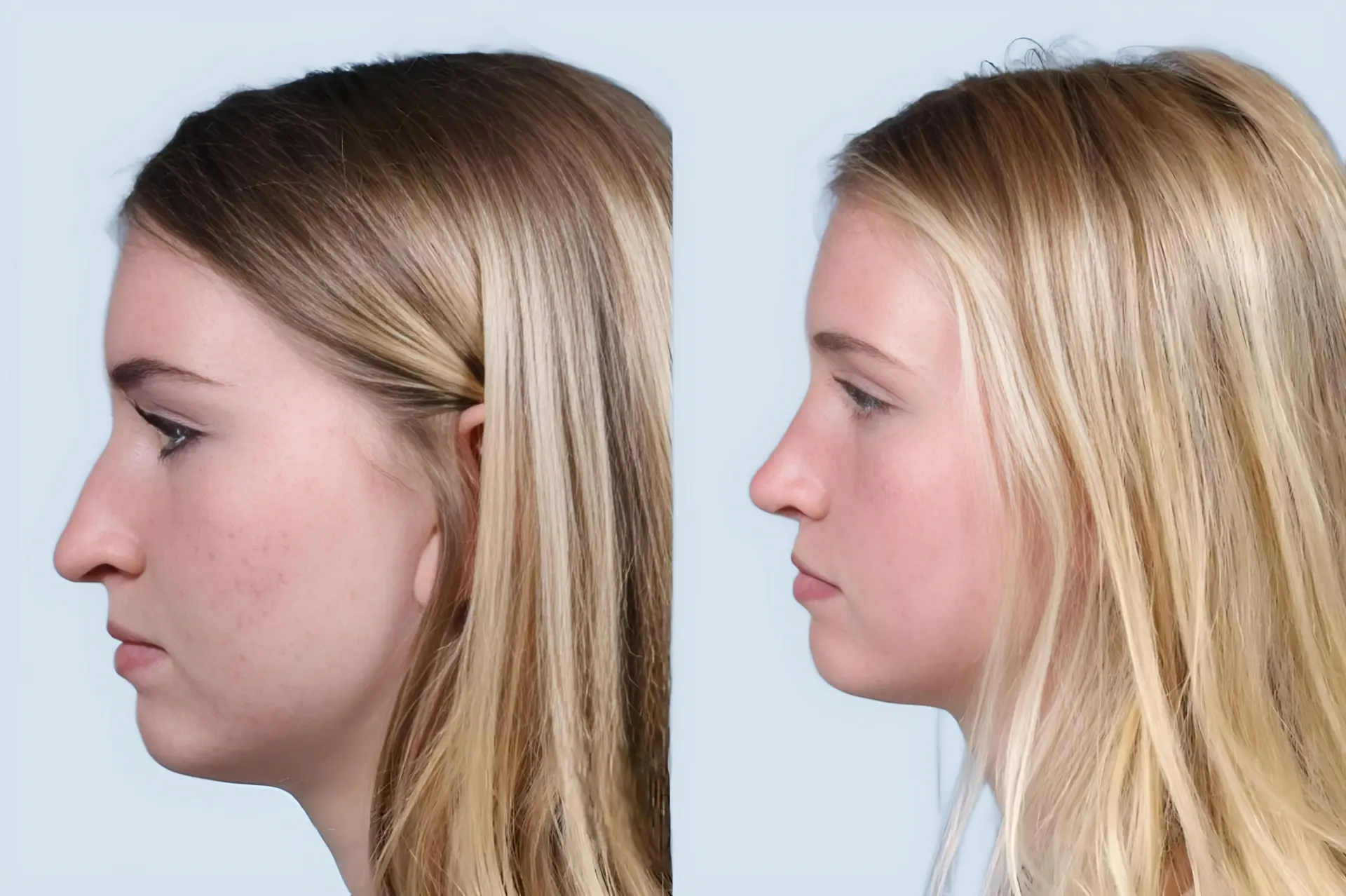 Rhinoplasty Turkey before and after Case 24