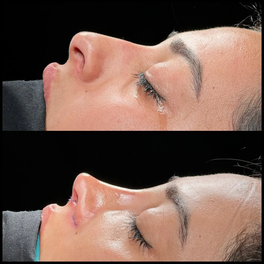 Rhinoplasty Turkey before and after Case 3