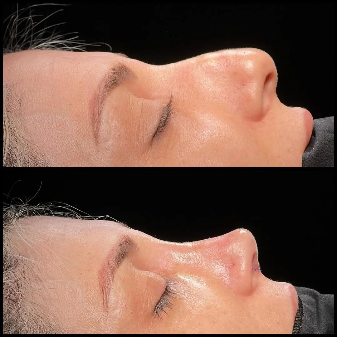 Rhinoplasty Turkey before and after Case 4