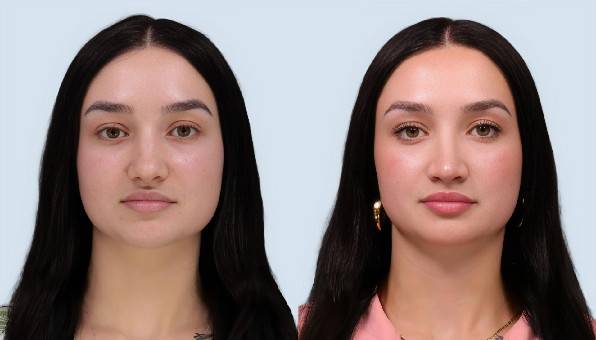 Rhinoplasty Turkey before and after Case 5