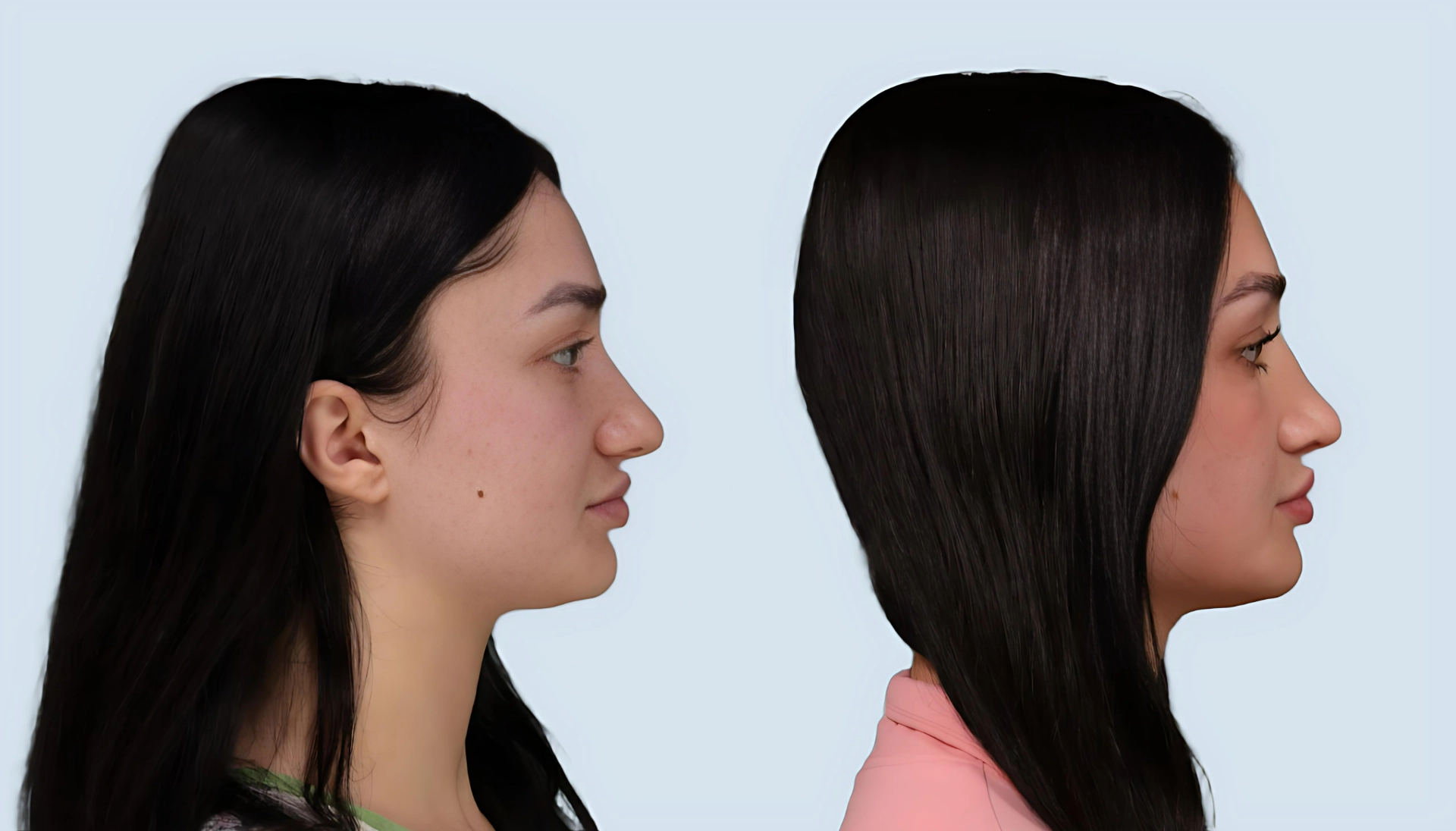 Rhinoplasty Turkey before and after Case 6