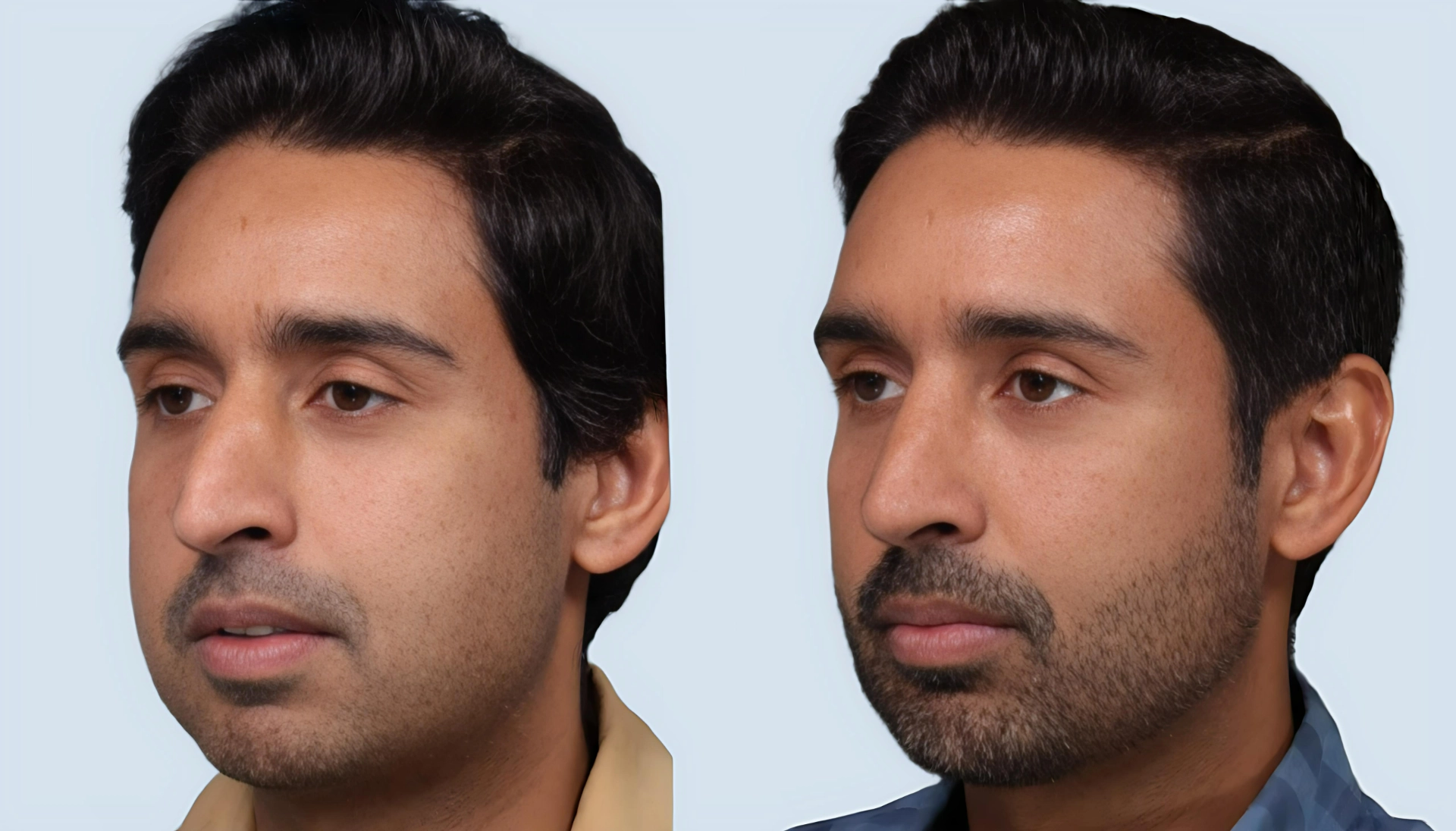 Rhinoplasty Turkey before and after Case 7
