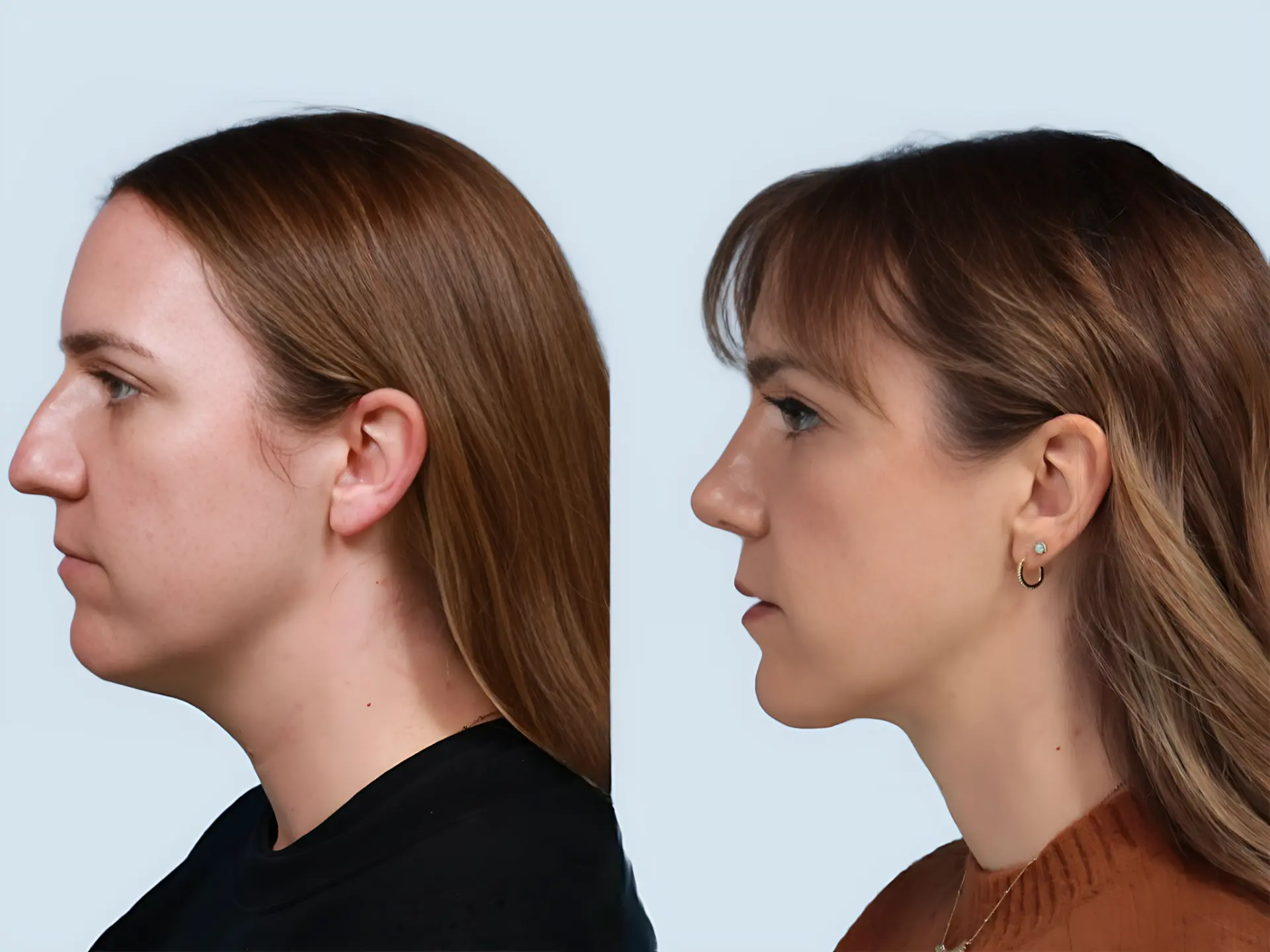 Rhinoplasty Turkey before and after Case 9