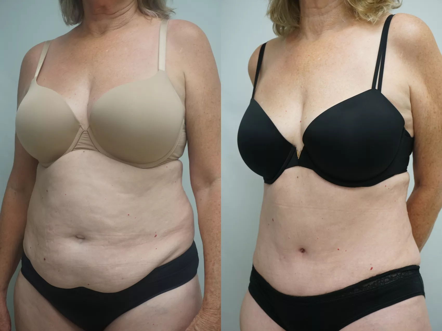 Tummy tuck Turkey results Case 10 - Weight loss skin removal