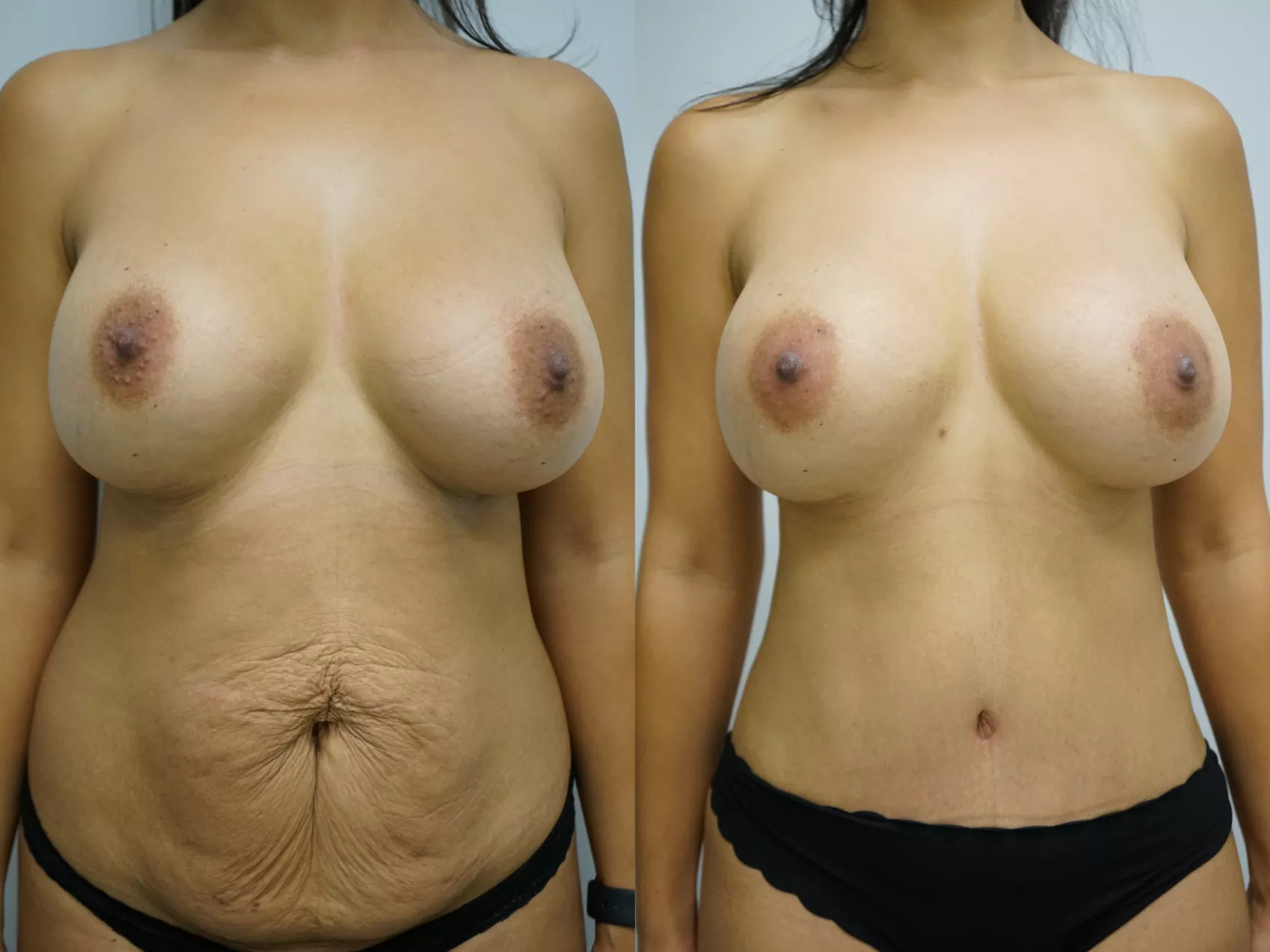 Tummy tuck before and after Turkey Case 11 - Full abdominoplasty results