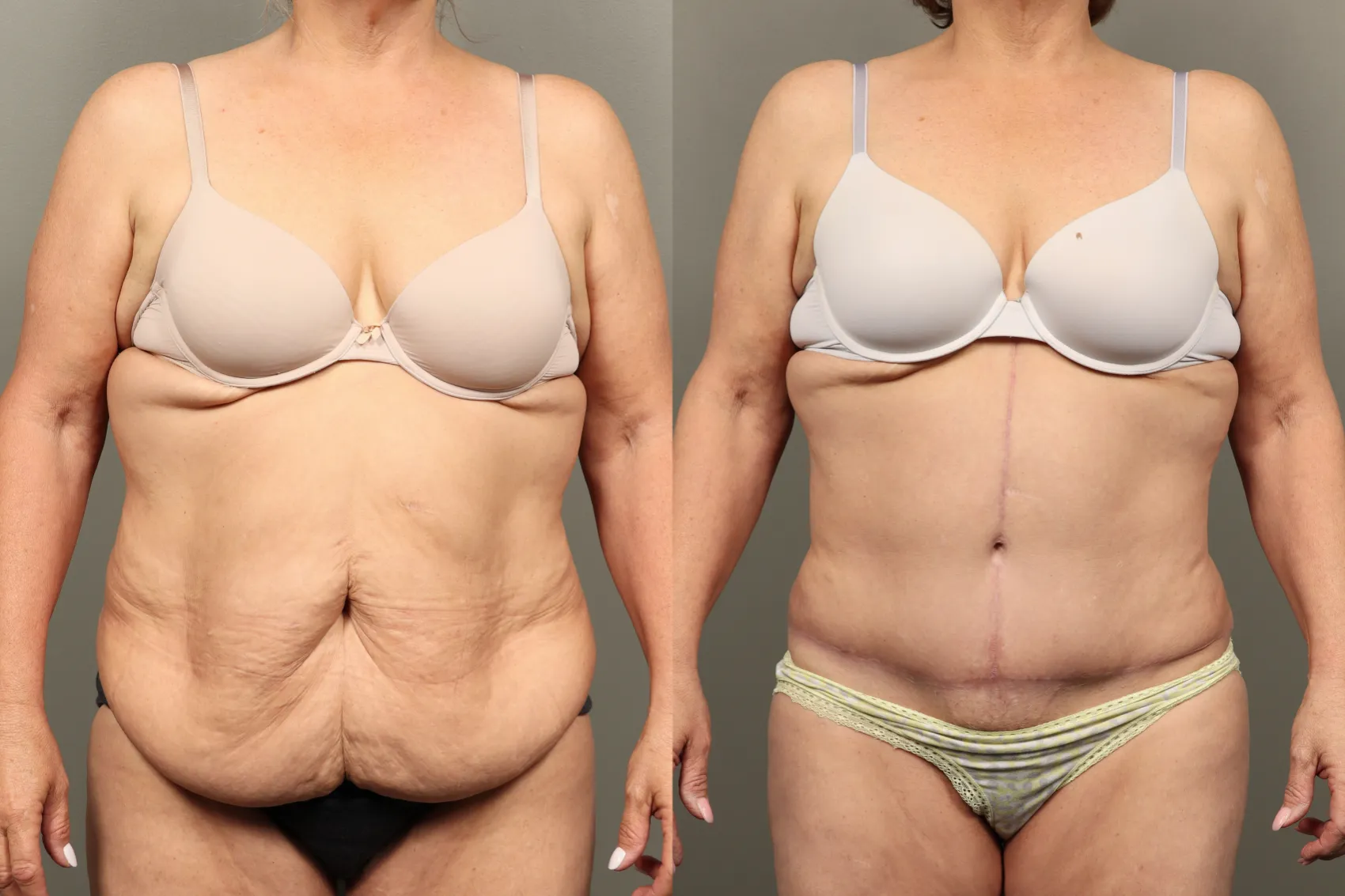 Abdominoplasty before after Case 12 - Tummy tuck surgery Turkey