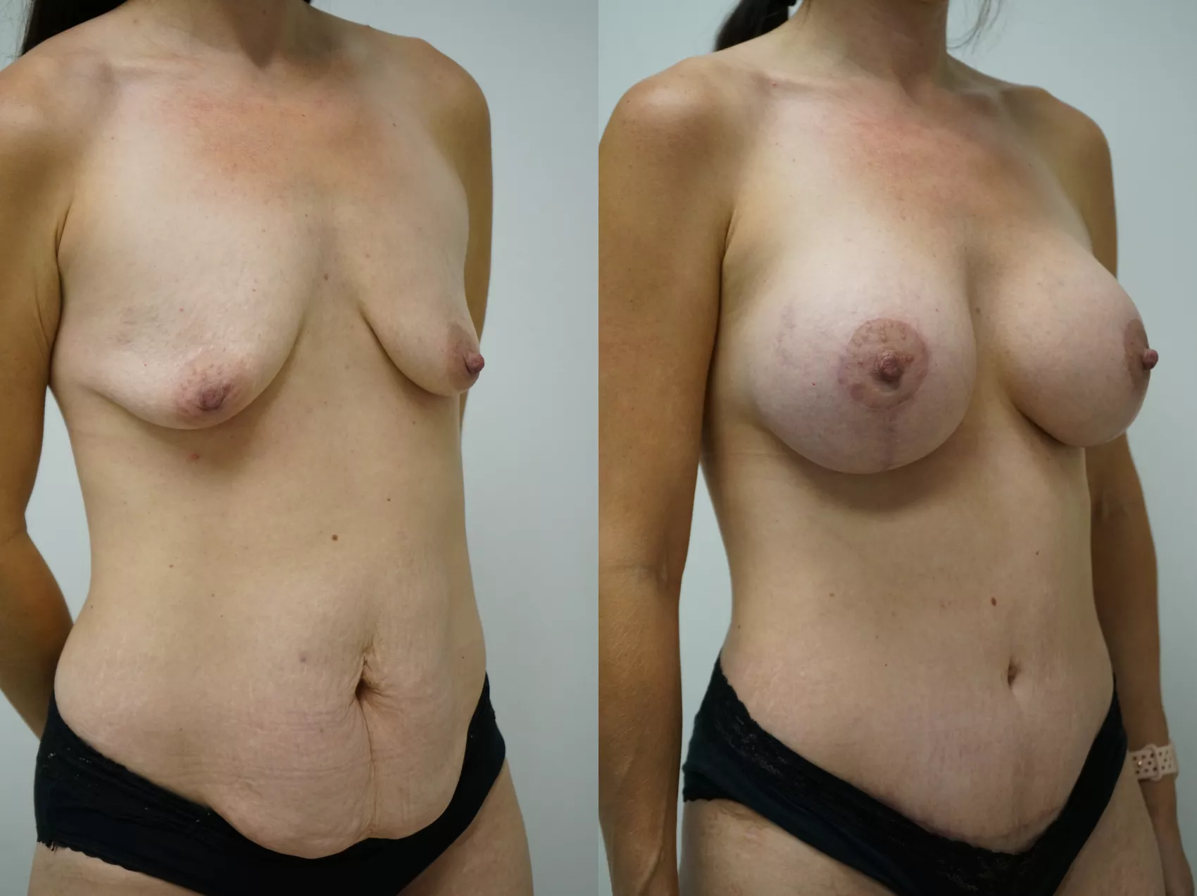 Tummy tuck Turkey Case 13 - Before and after stomach surgery