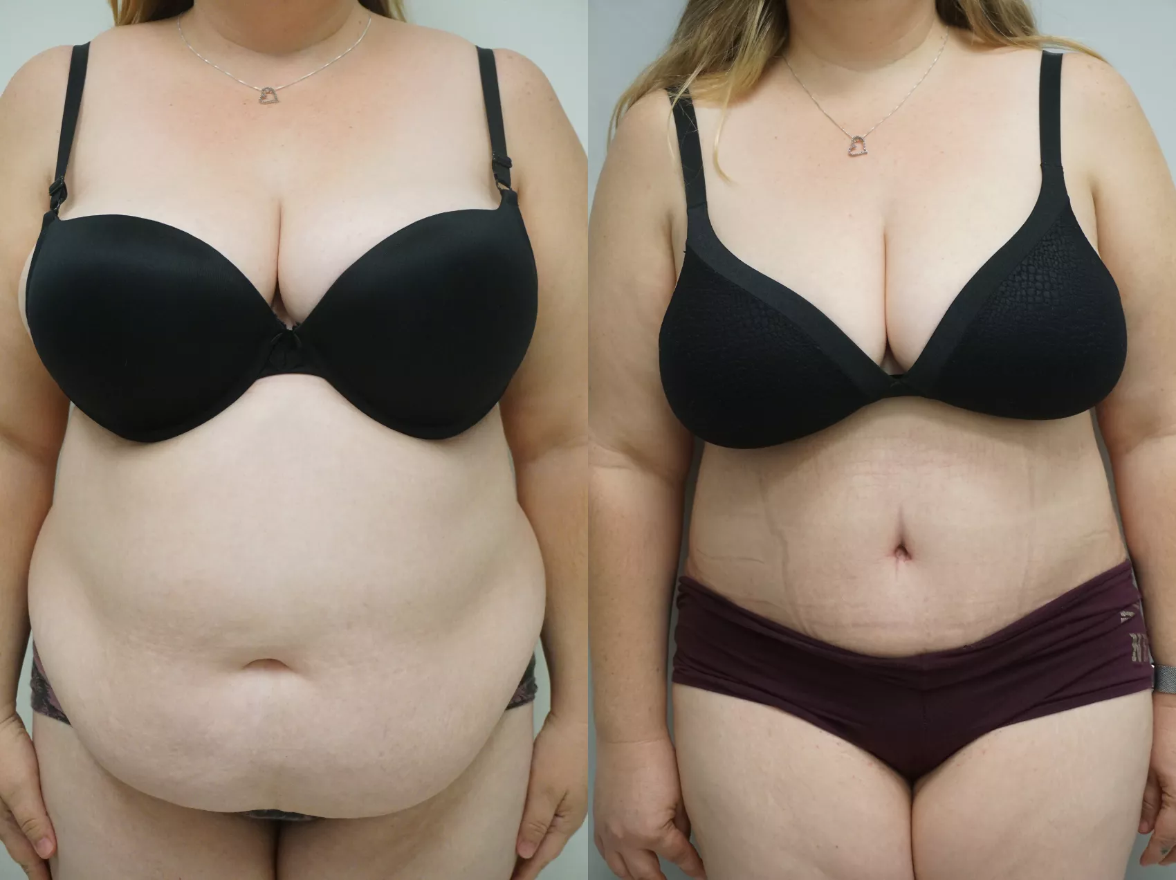 Tummy tuck Turkey before and after Case 2 - Flat stomach results at Carely Clinic