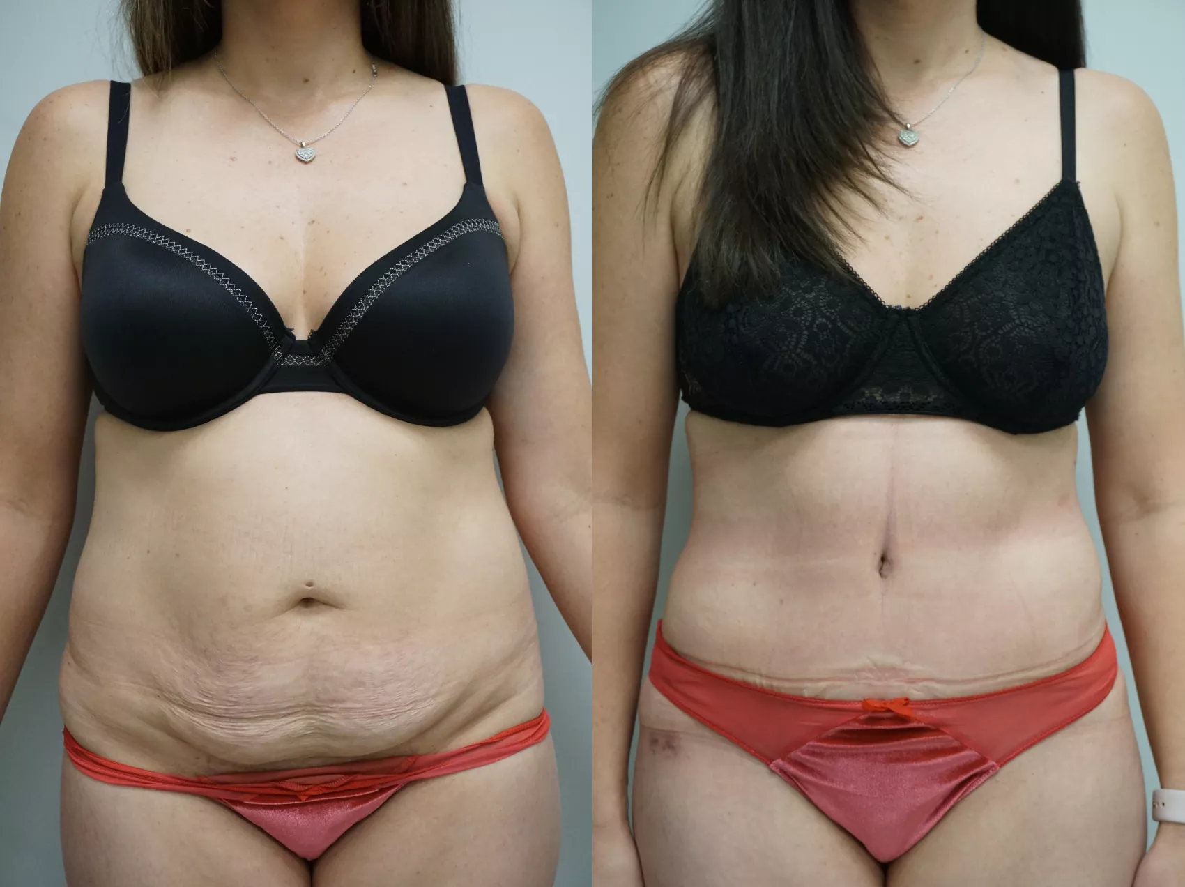 Tummy tuck before after Turkey Case 14 - Abdominoplasty final results