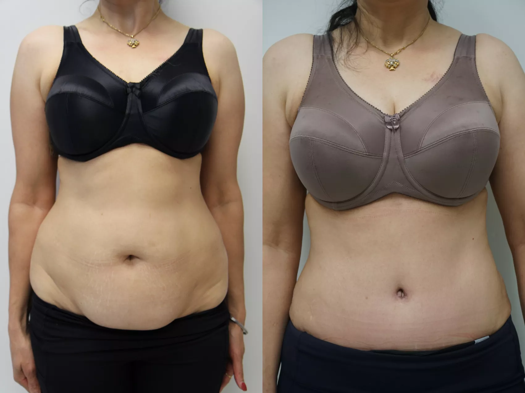 Tummy tuck Turkey results Case 15 - Flat stomach transformation