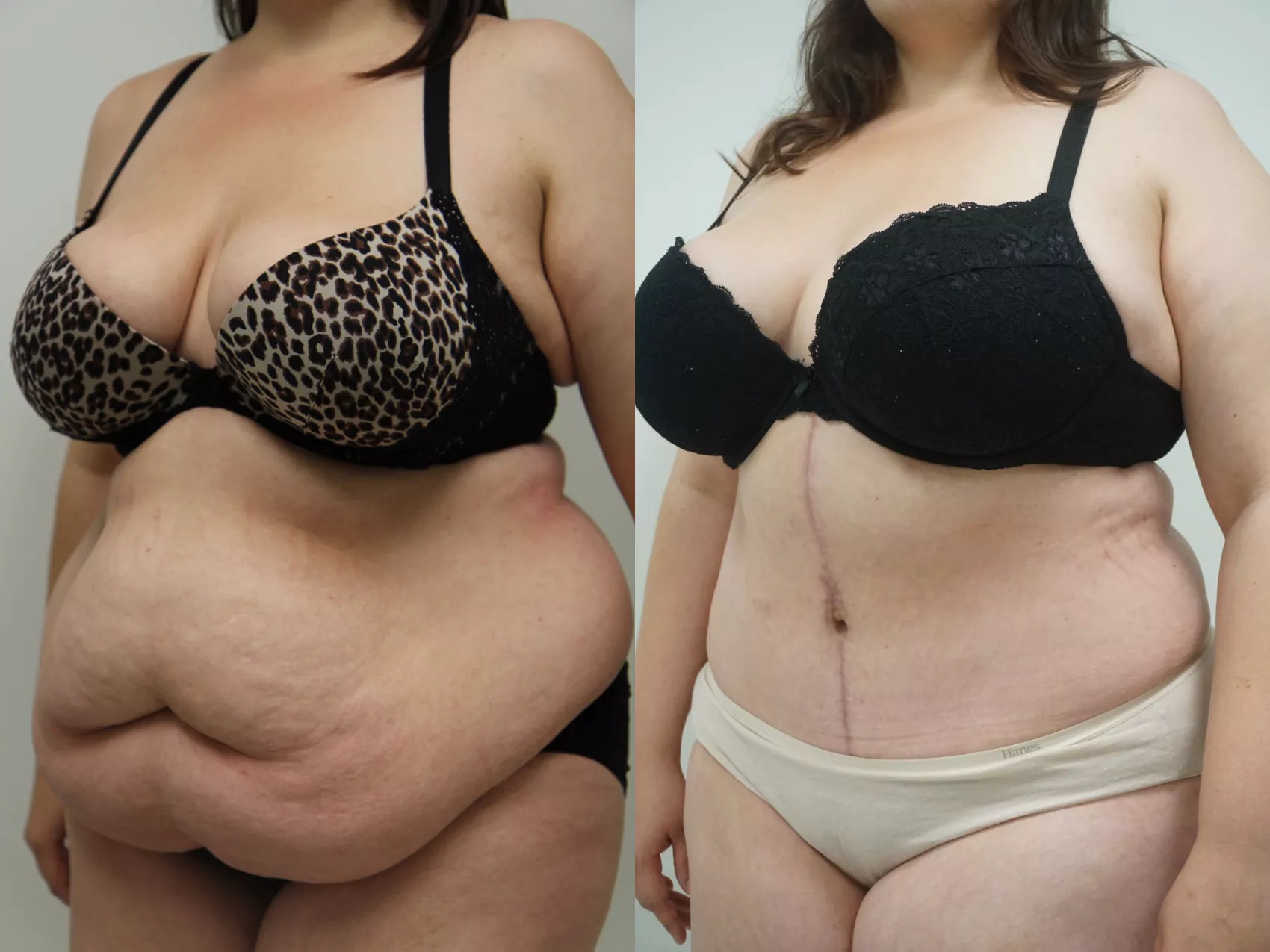 Abdominoplasty Turkey before after Case 3 - Excess skin removed at Carely Clinic