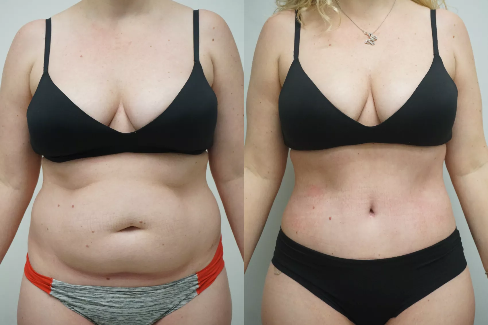 Tummy tuck Turkey results Case 4 - Before and after abdominoplasty surgery