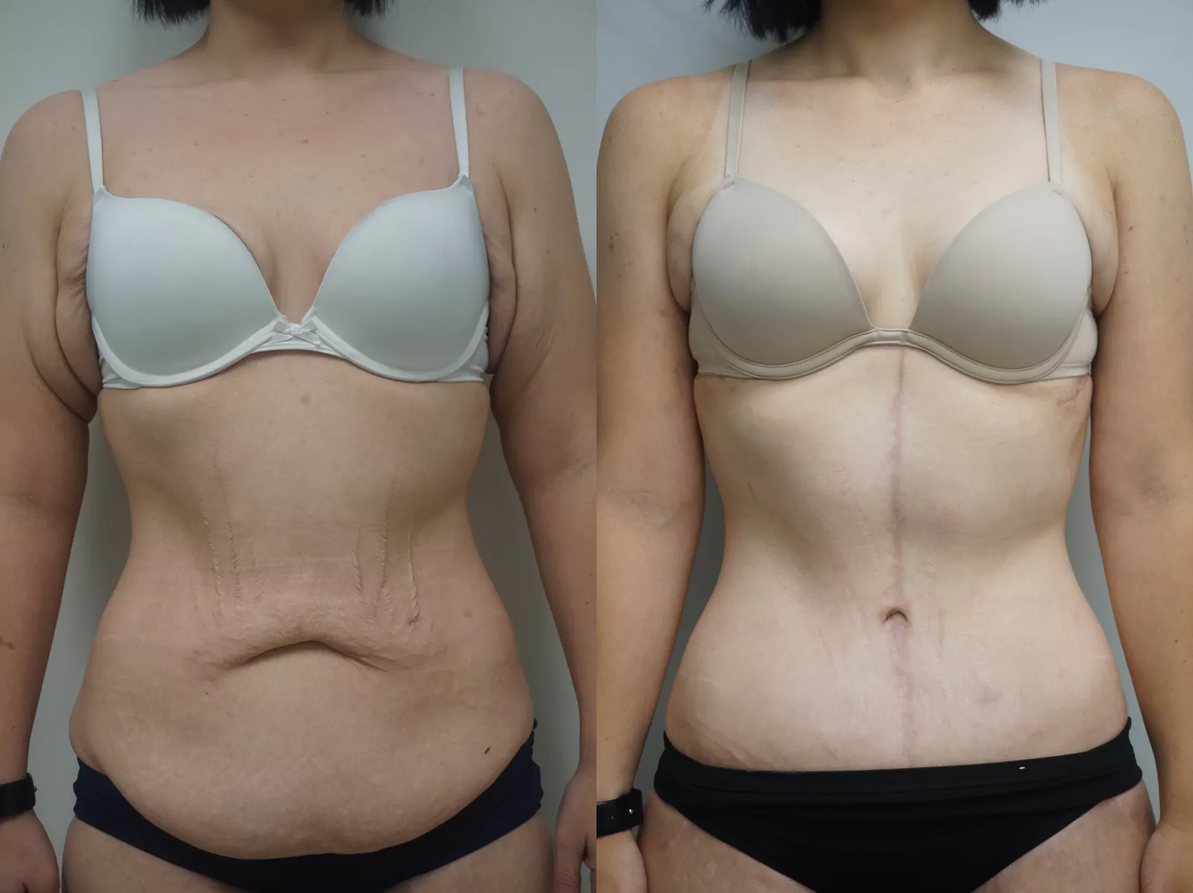 Abdominoplasty before and after Turkey Case 6 - Flat abdomen achieved