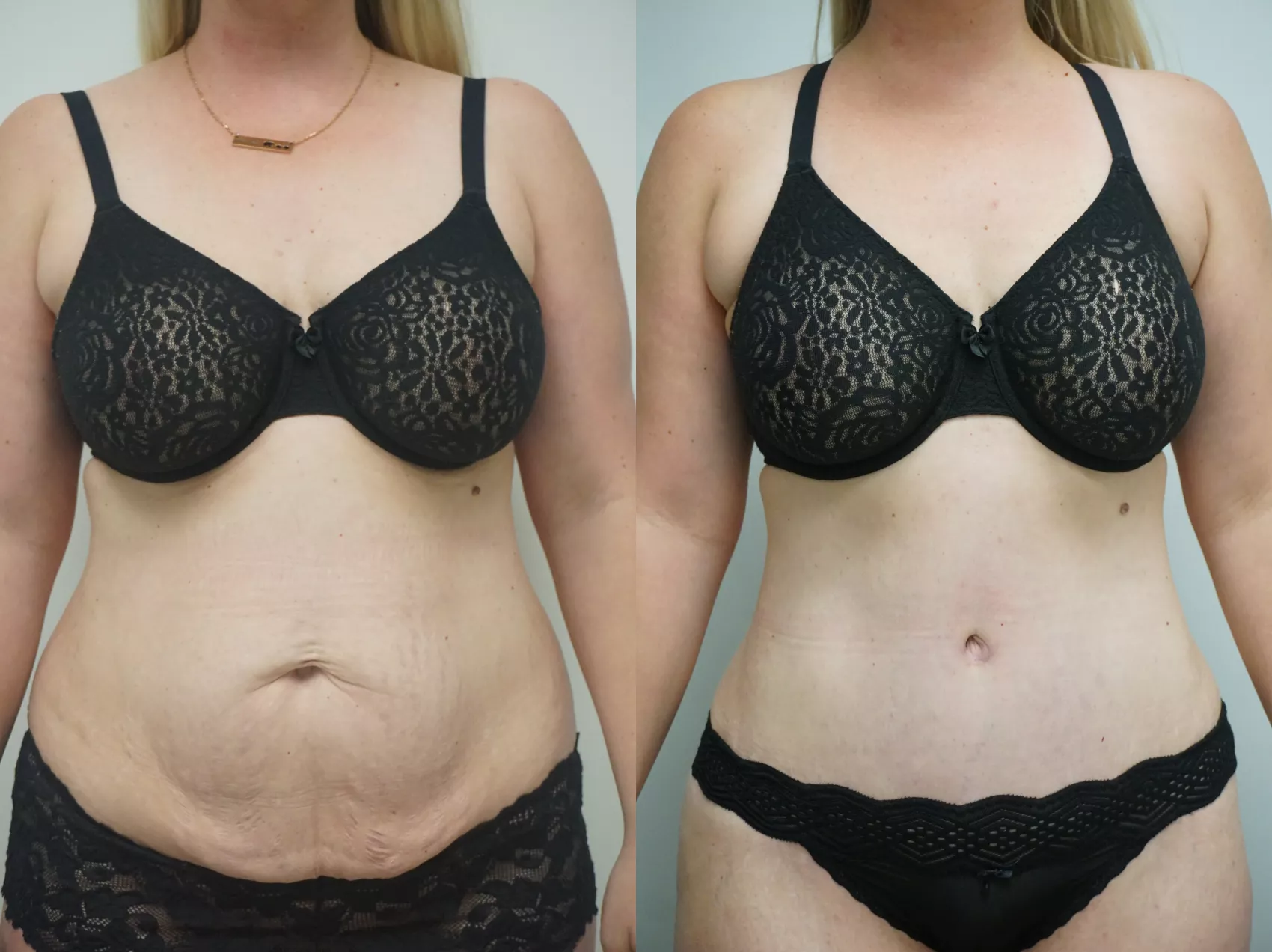Tummy tuck Turkey before and after Case 7 - Post-pregnancy transformation