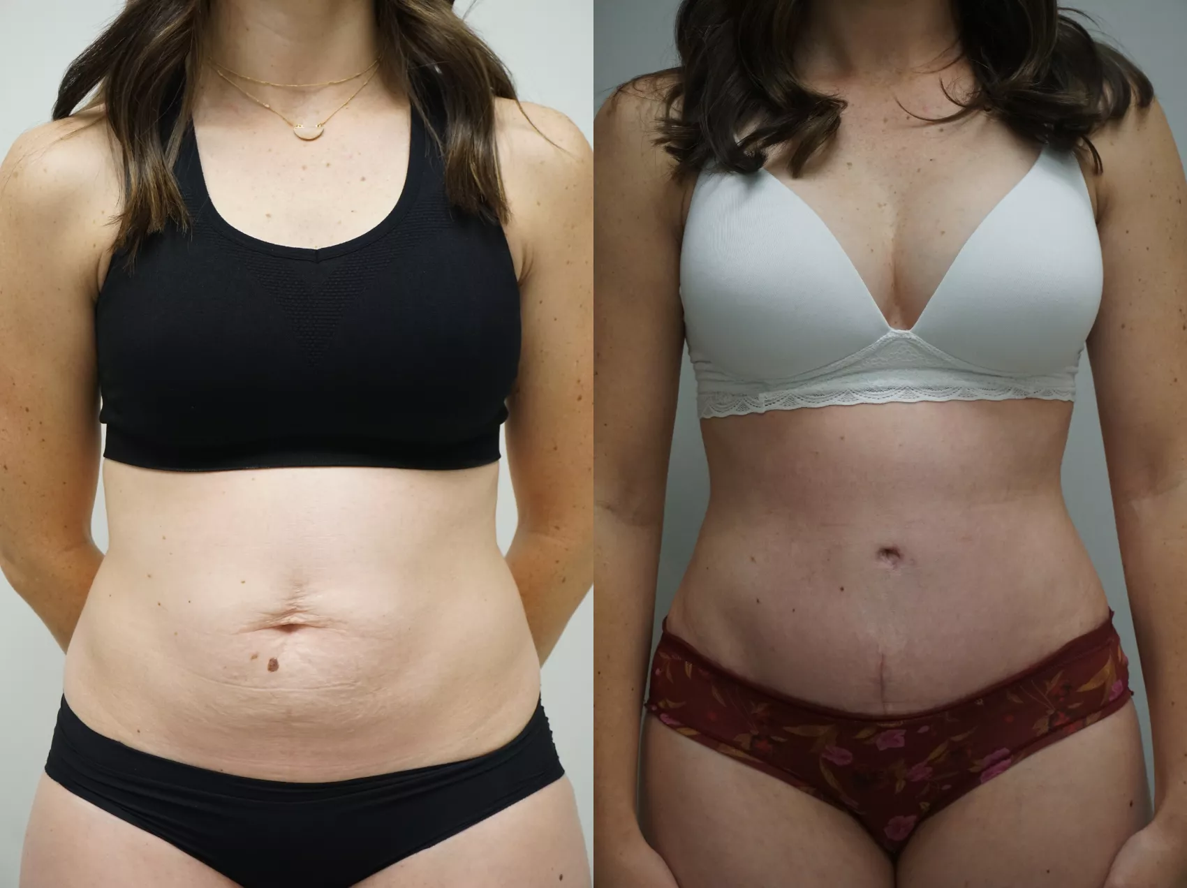Tummy tuck before after Istanbul Case 8 - Skin removal results