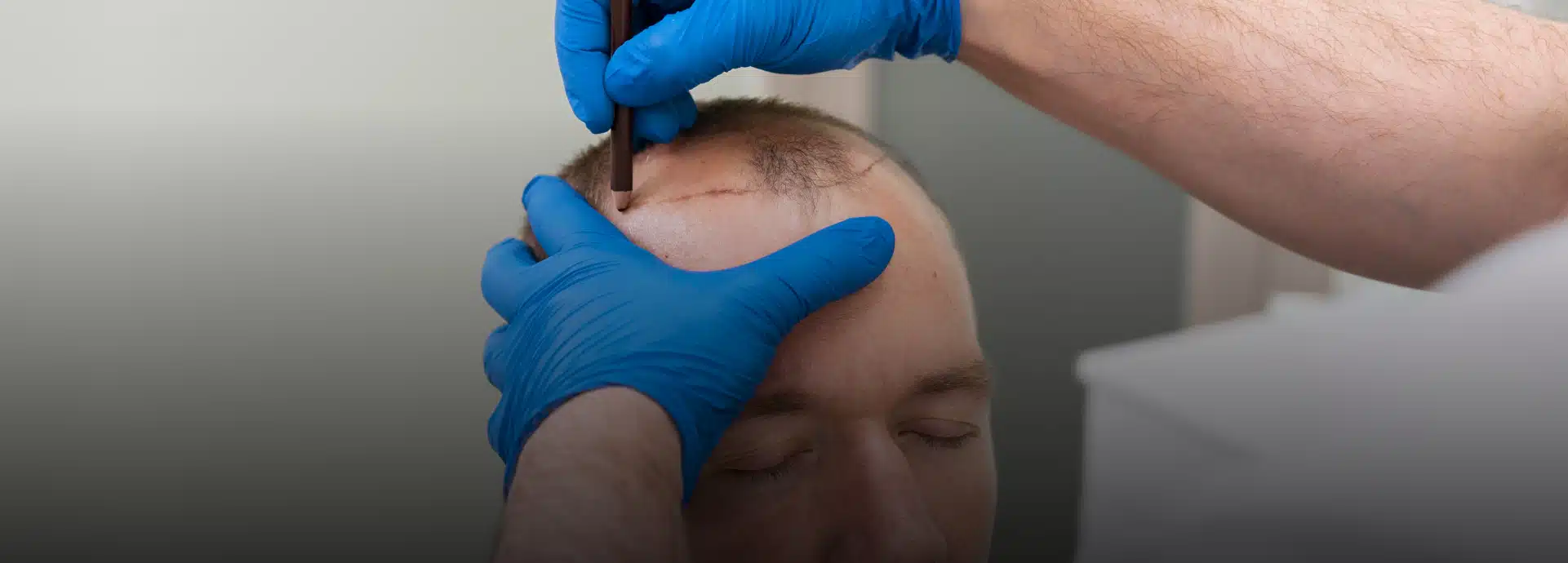 Hair Transplant Graft Calculator guide 2026